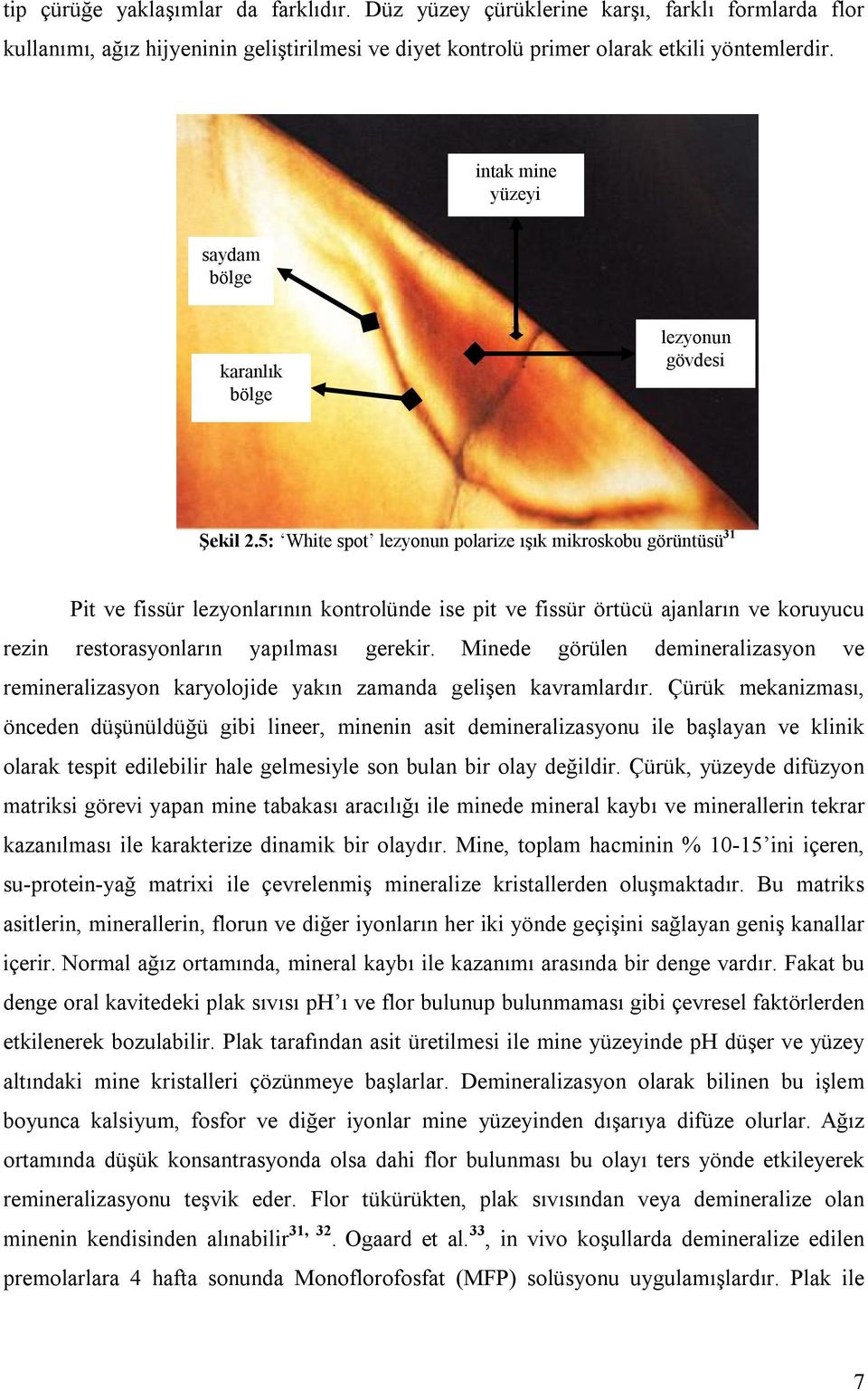 5: White spot lezyonun polarize ışık mikroskobu görüntüsü 31 Pit ve fissür lezyonlarının kontrolünde ise pit ve fissür örtücü ajanların ve koruyucu rezin restorasyonların yapılması gerekir.