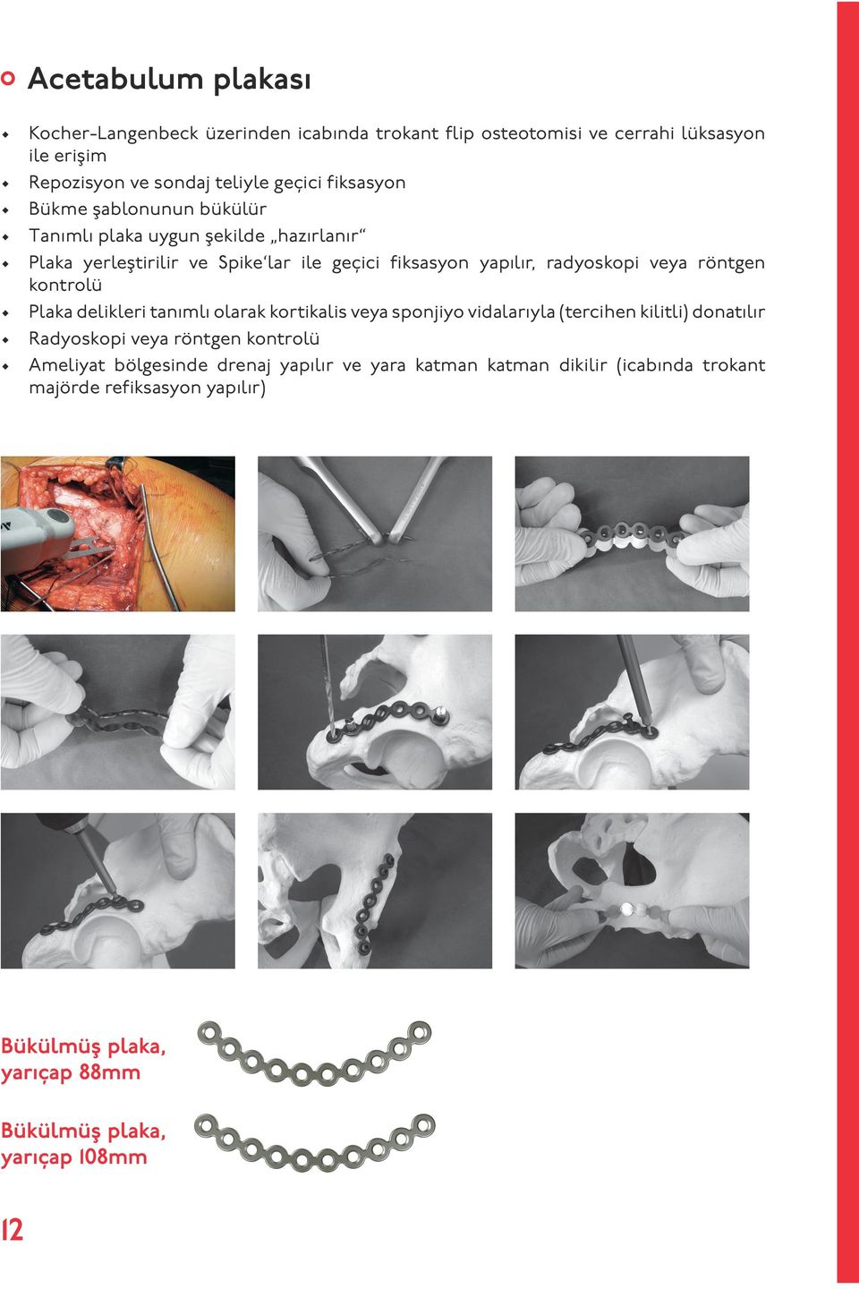 röntgen kontrolü Plaka delikleri tanımlı olarak kortikalis veya sponjiyo vidalarıyla (tercihen kilitli) donatılır Radyoskopi veya röntgen kontrolü Ameliyat