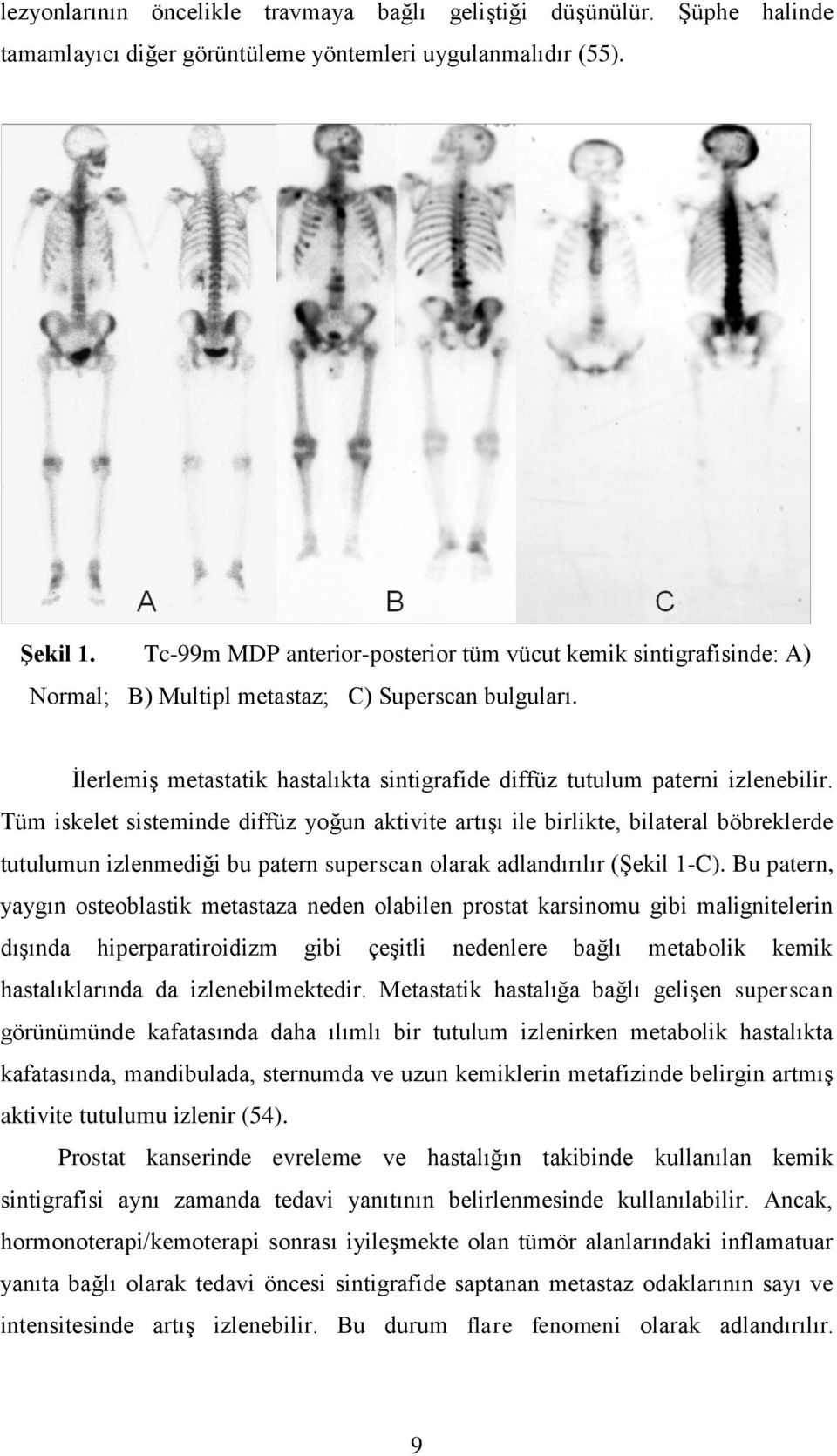 Tüm iskelet sisteminde diffüz yoğun aktivite artışı ile birlikte, bilateral böbreklerde tutulumun izlenmediği bu patern superscan olarak adlandırılır (Şekil 1-C).