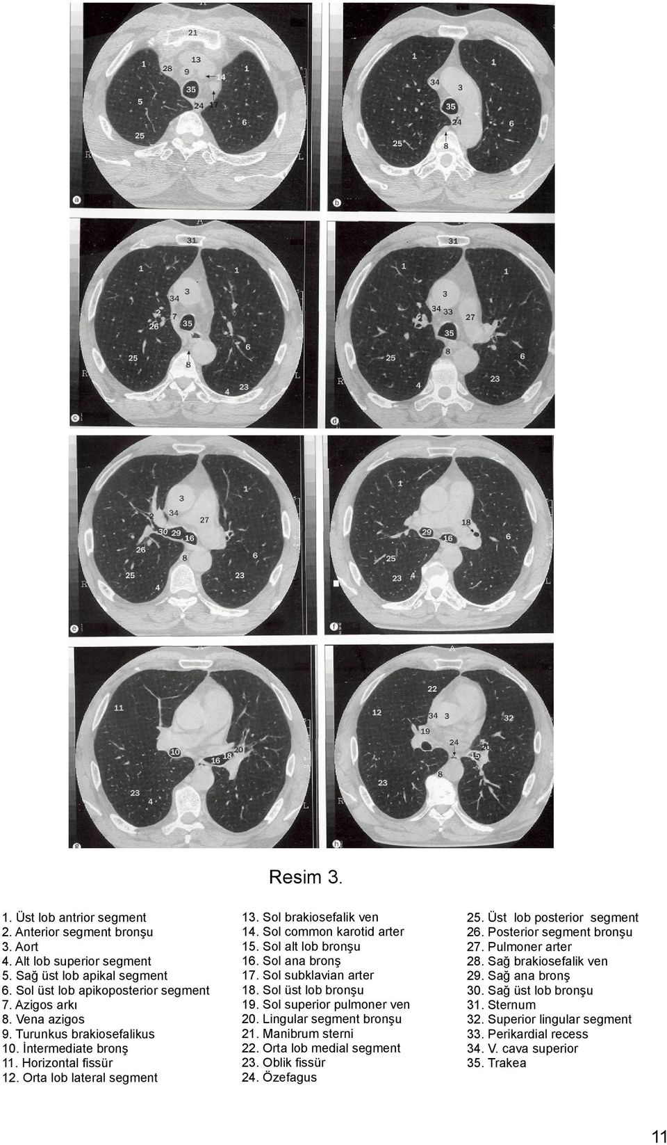 Sol subklavian arter 18. Sol üst lob bronşu 19. Sol superior pulmoner ven 20. Lingular segment bronşu 21. Manibrum sterni 22. Orta lob medial segment 23. Oblik fissür 24. Özefagus 25.