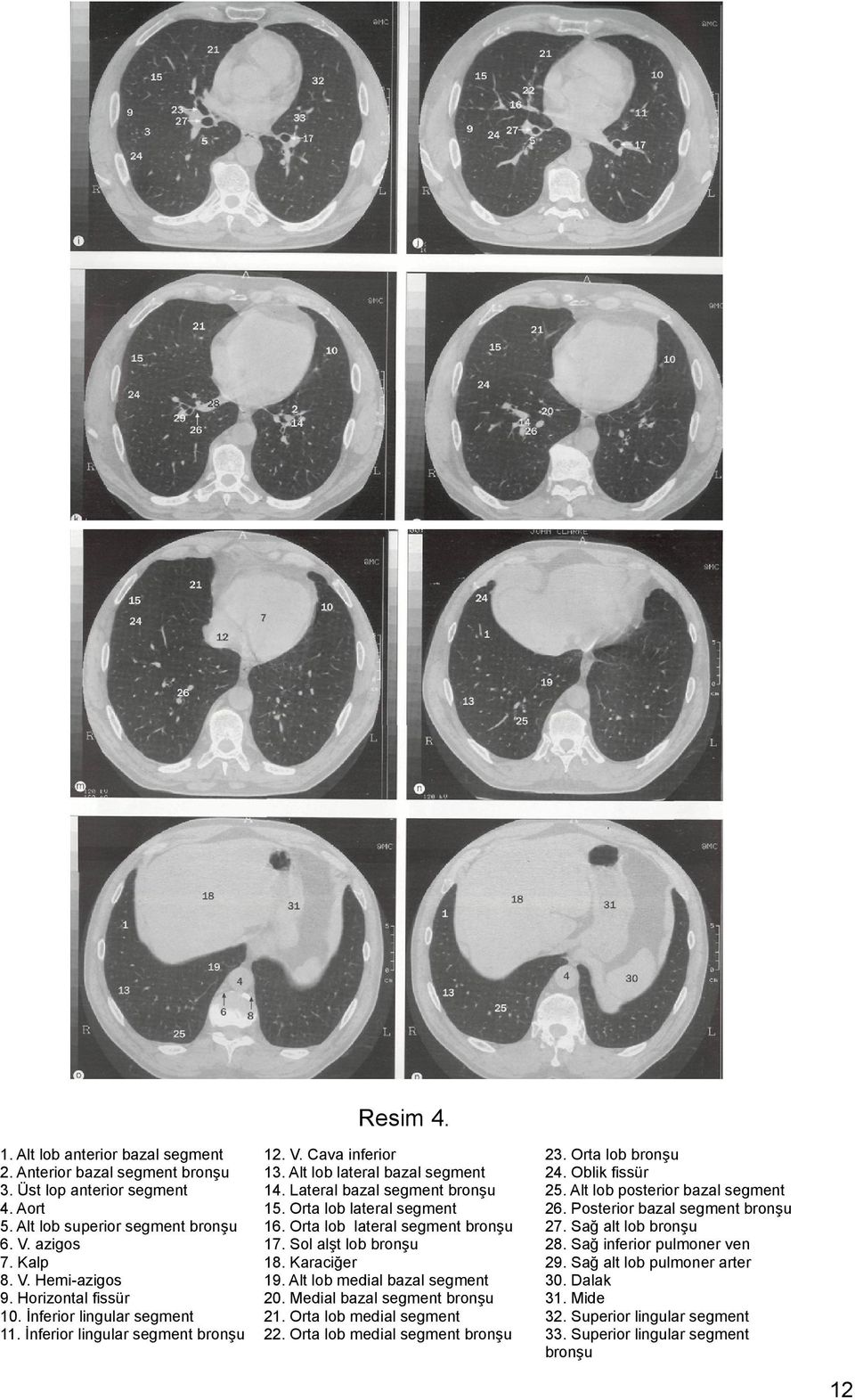 Orta lob lateral segment 16. Orta lob lateral segment bronşu 17. Sol alşt lob bronşu 18. Karaciğer 19. Alt lob medial bazal segment 20. Medial bazal segment bronşu 21. Orta lob medial segment 22.