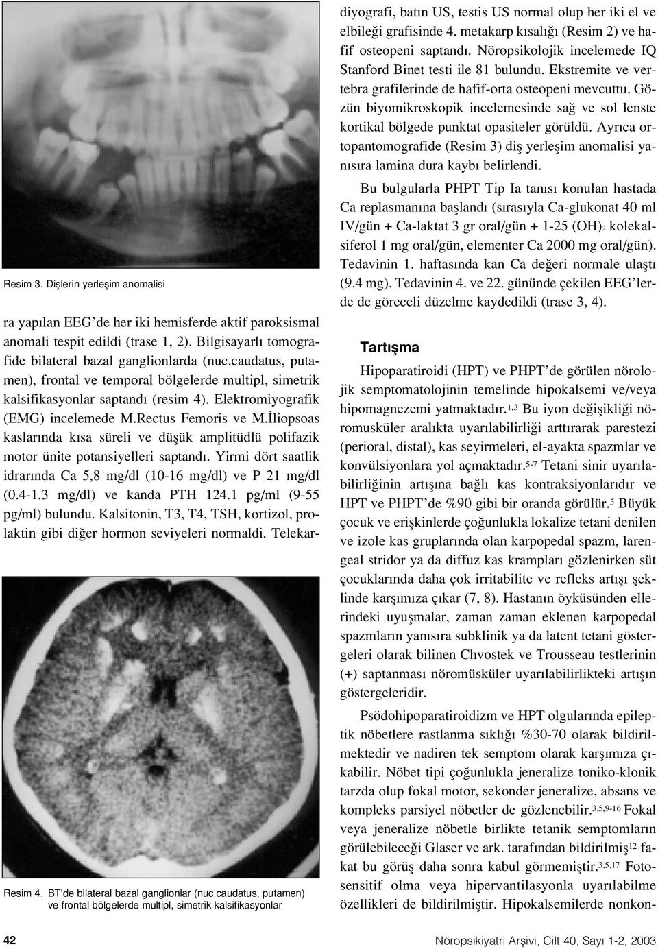 Bilgisayarl tomografide bilateral bazal ganglionlarda (nuc.caudatus, putamen), frontal ve temporal bölgelerde multipl, simetrik kalsifikasyonlar saptand (resim 4).