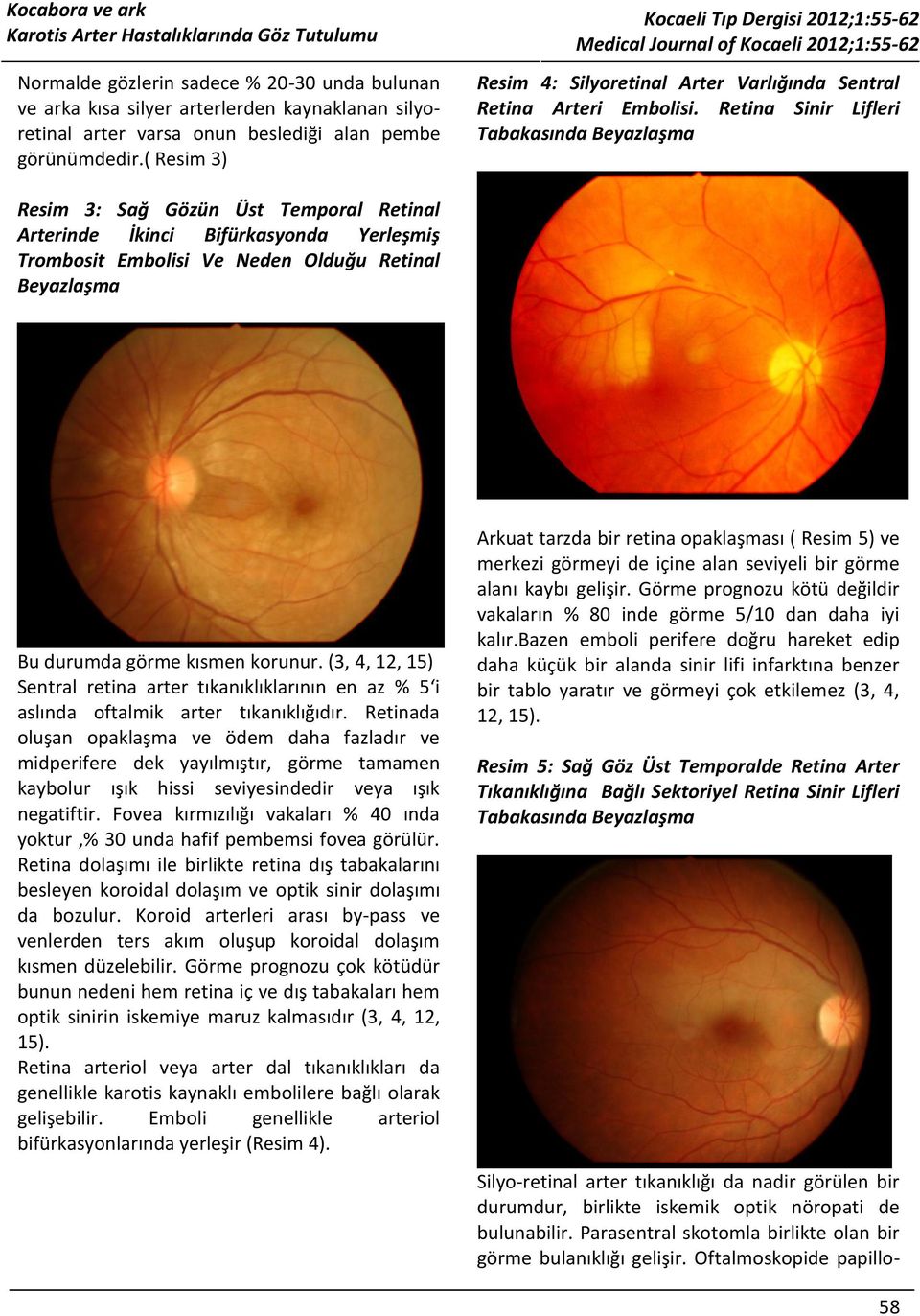 Retina Sinir Lifleri Tabakasında Beyazlaşma Resim 3: Sağ Gözün Üst Temporal Retinal Arterinde İkinci Bifürkasyonda Yerleşmiş Trombosit Embolisi Ve Neden Olduğu Retinal Beyazlaşma Bu durumda görme