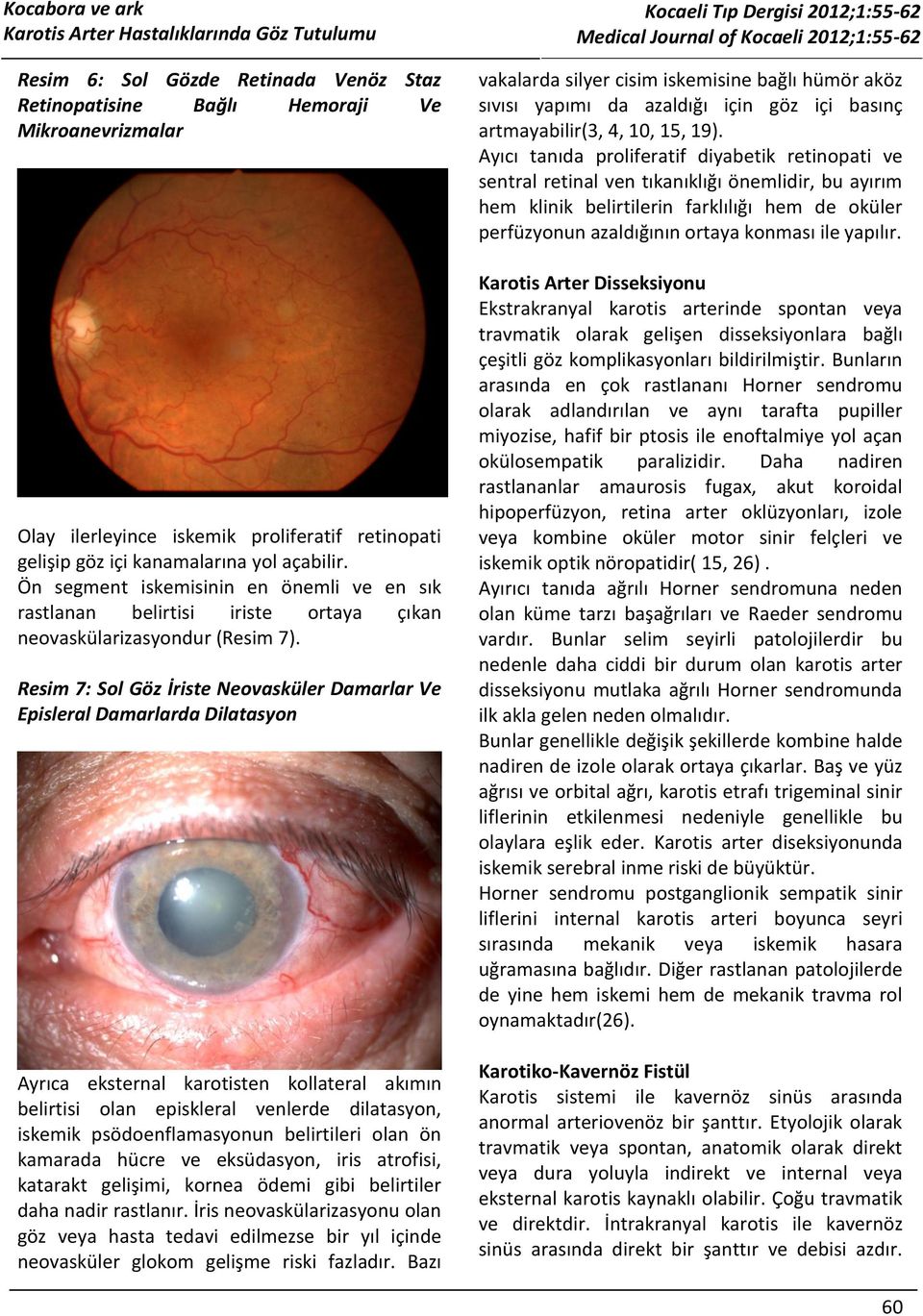 Resim 7: Sol Göz İriste Neovasküler Damarlar Ve Episleral Damarlarda Dilatasyon Ayrıca eksternal karotisten kollateral akımın belirtisi olan episkleral venlerde dilatasyon, iskemik psödoenflamasyonun