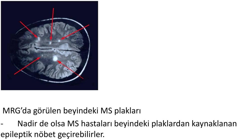 hastaları beyindeki plaklardan