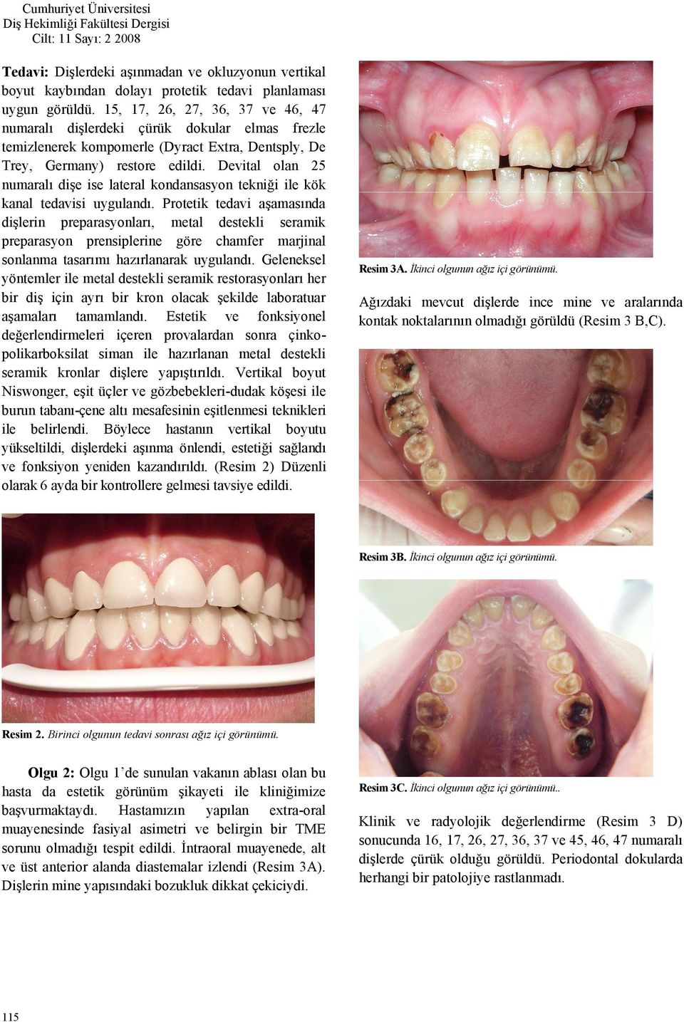 Devital olan 25 numaralı dişe ise lateral kondansasyon tekniği ile kök kanal tedavisi uygulandı.