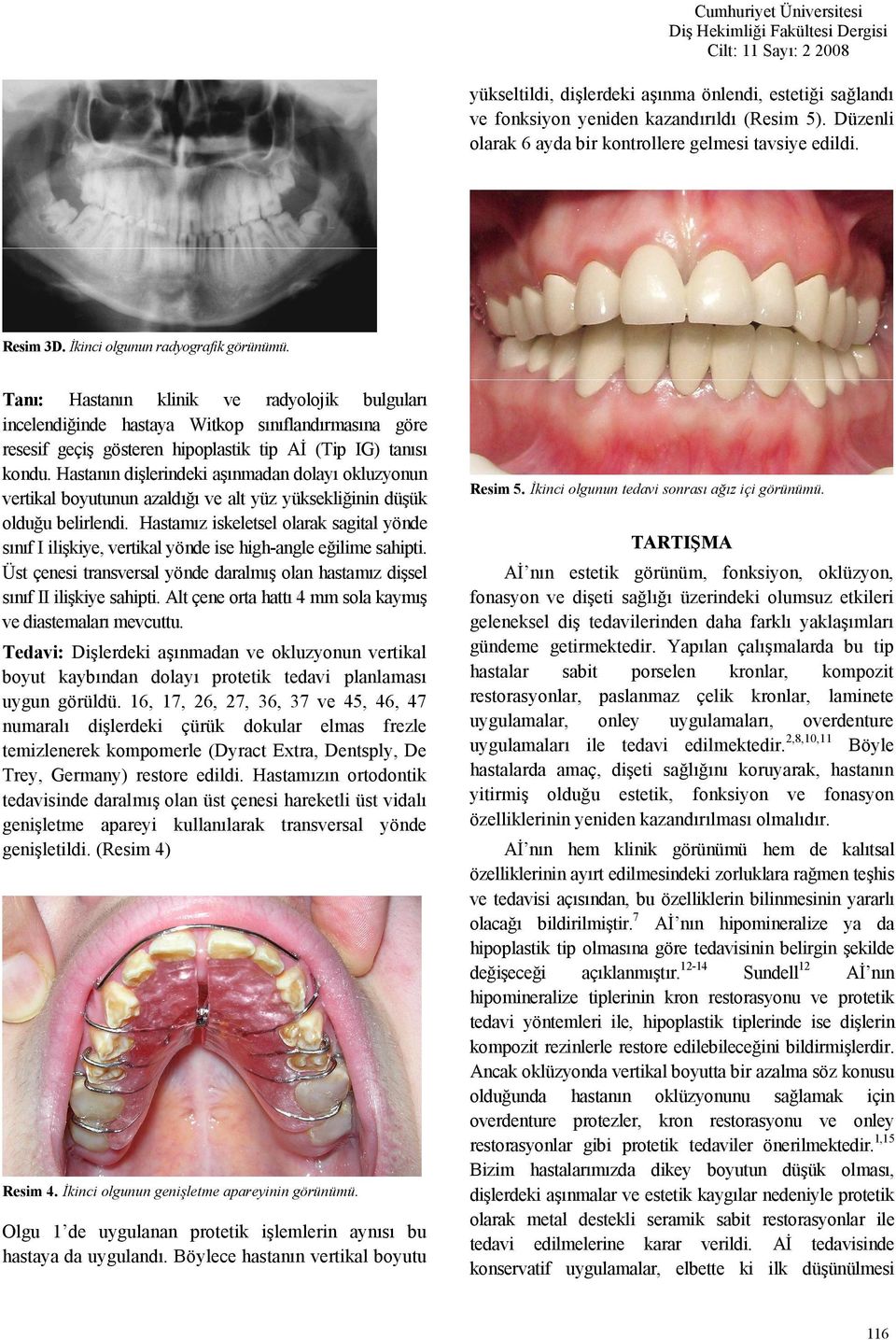Hastanın dişlerindeki aşınmadan dolayı okluzyonun vertikal boyutunun azaldığı ve alt yüz yüksekliğinin düşük olduğu belirlendi.