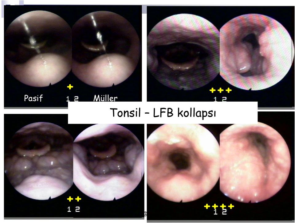 Tonsil LFB