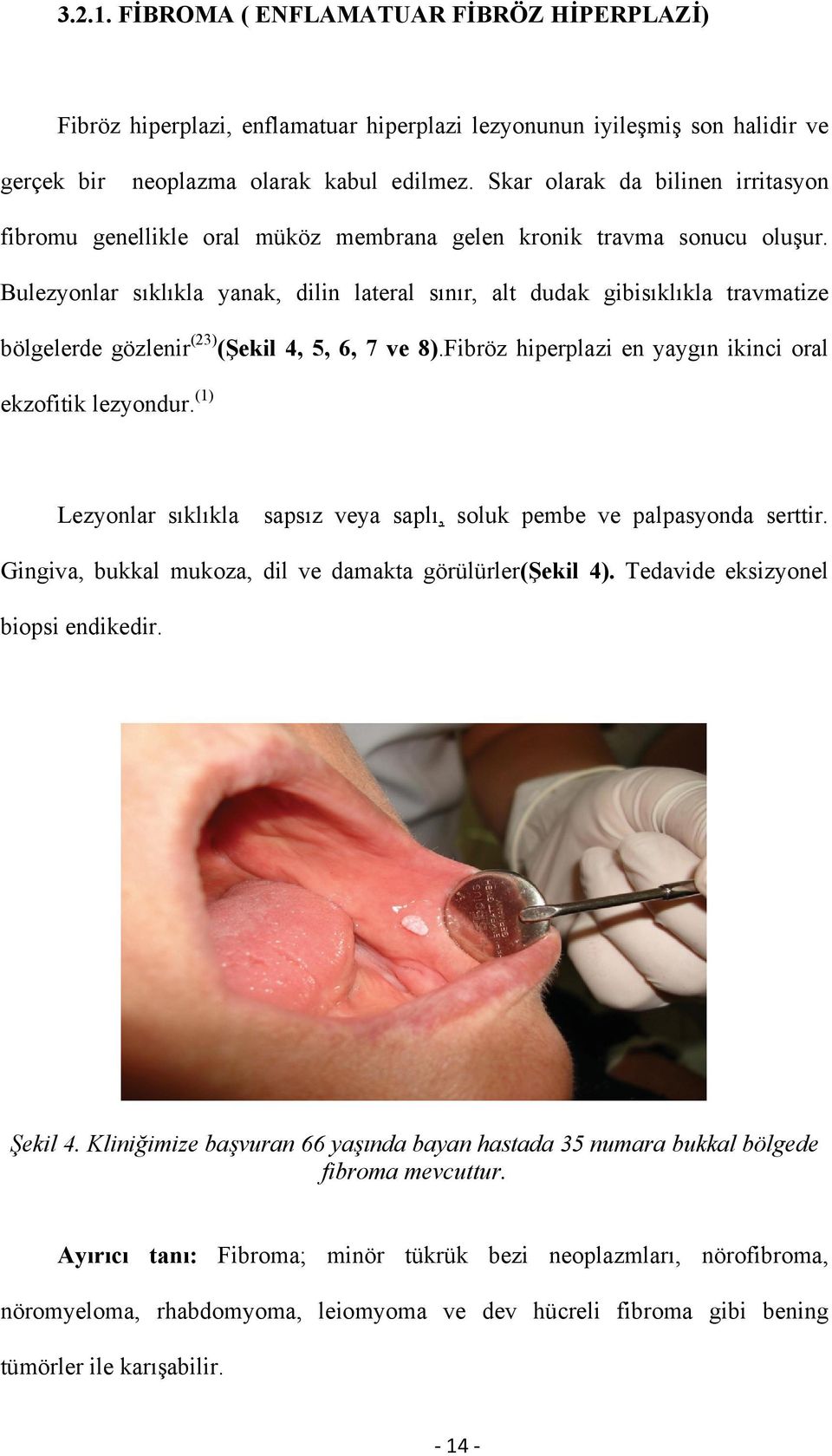 Bulezyonlar sıklıkla yanak, dilin lateral sınır, alt dudak gibisıklıkla travmatize bölgelerde gözlenir (23) (Şekil 4, 5, 6, 7 ve 8).Fibröz hiperplazi en yaygın ikinci oral ekzofitik lezyondur.