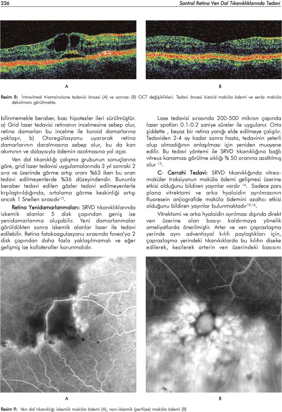 a) Grid lazer tedavisi retinanýn incelmesine sebep olur, retina damarlarý bu incelme ile koroid damarlarýna yaklaþýr, b) Otoregülasyonu uyararak retina damarlarýnýn daralmasýna sebep olur, bu da kan