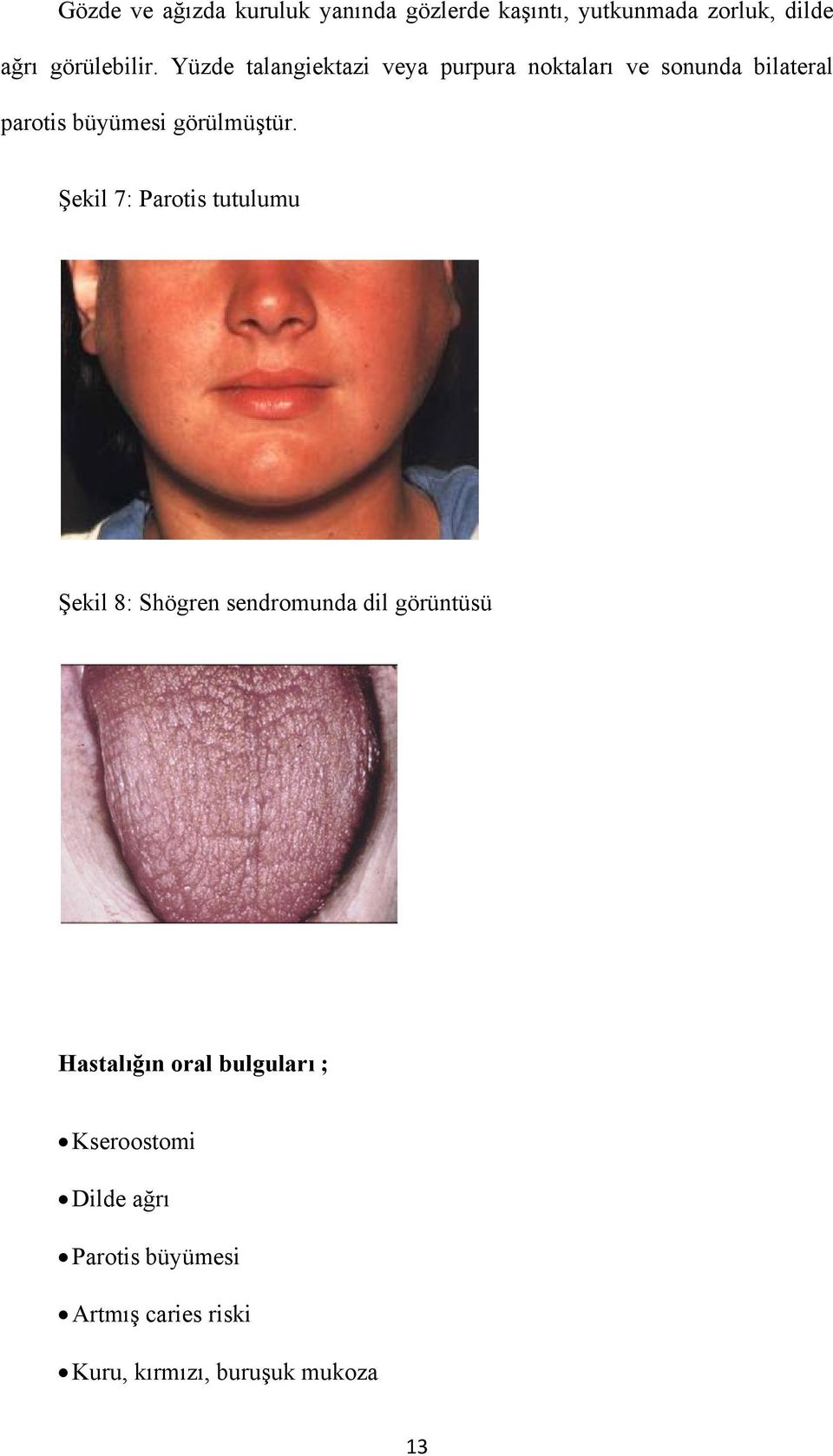 Şekil 7: Parotis tutulumu Şekil 8: Shögren sendromunda dil görüntüsü Hastalığın oral