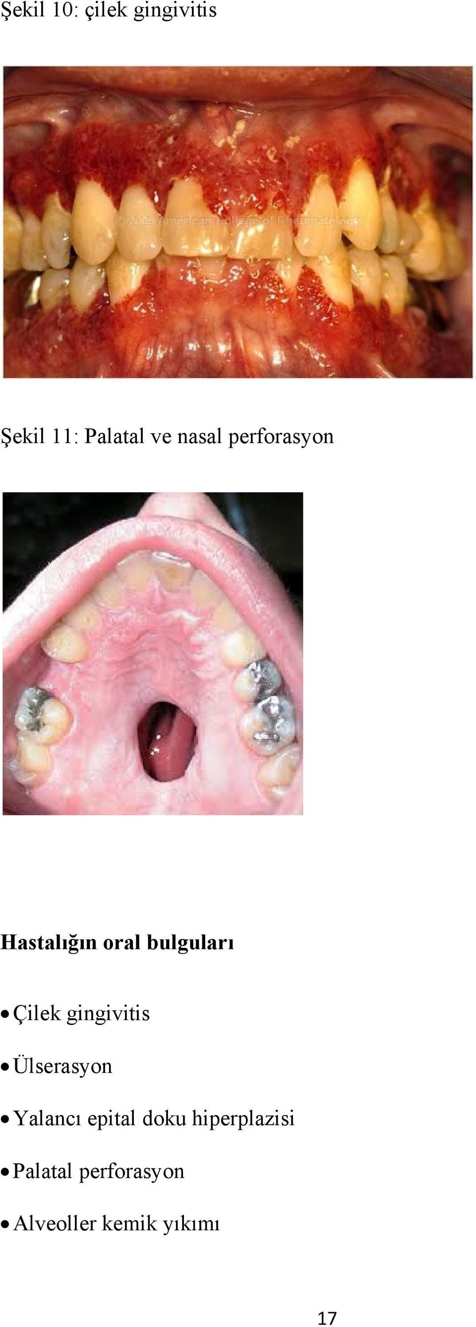 gingivitis Ülserasyon Yalancı epital doku