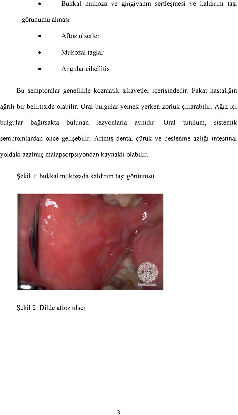 Ağız içi bulgular bağırsakta bulunan lezyonlarla aynıdır. Oral tutulum, sistemik semptomlardan önce gelişebilir.