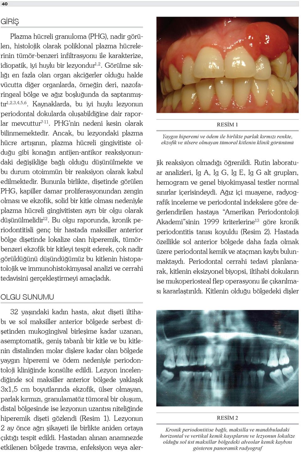 Kaynaklarda, bu iyi huylu lezyonun periodontal dokularda oluşabildiğine dair raporlar mevcuttur 7-11. PHG nin nedeni kesin olarak bilinmemektedir.