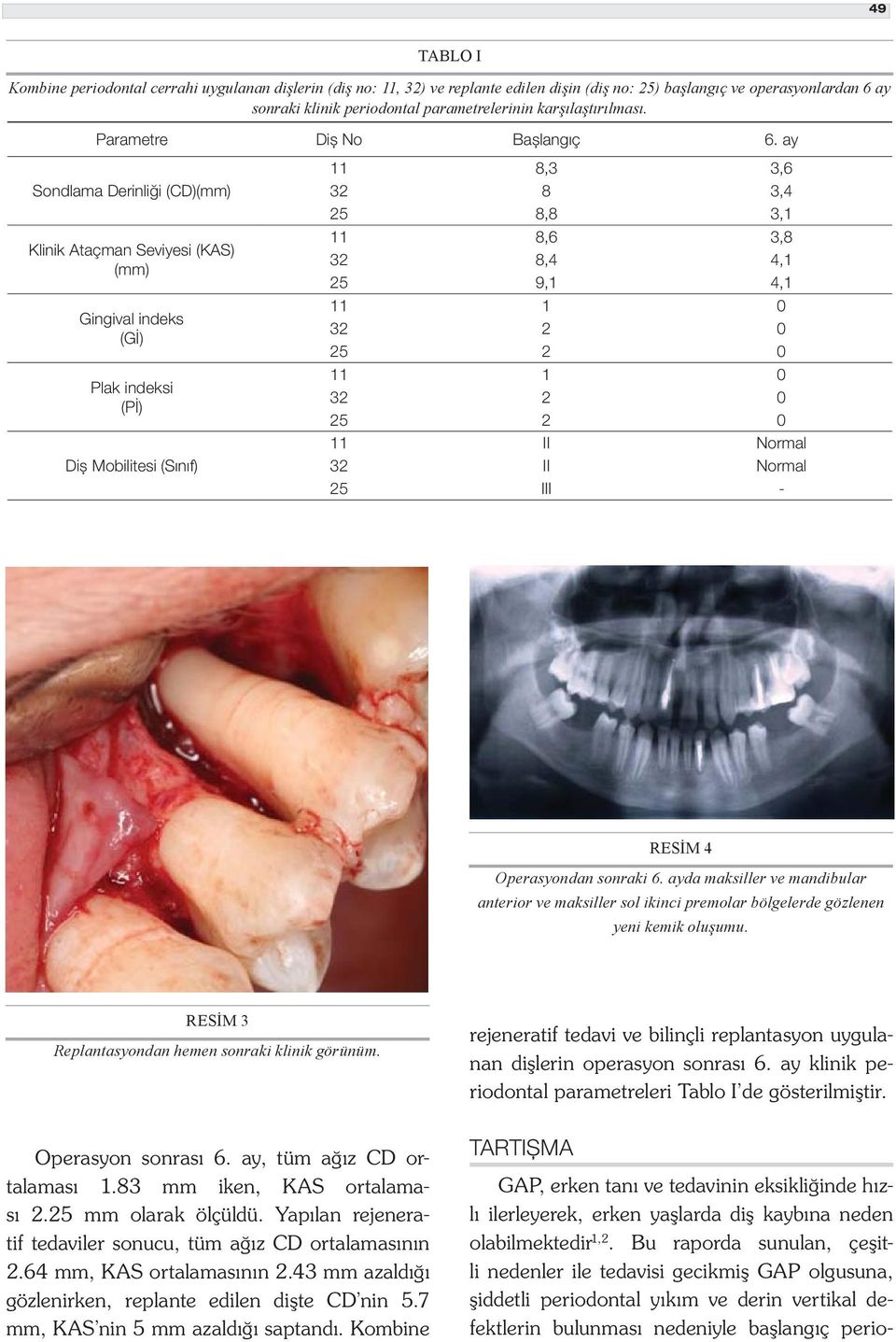 ay Sondlama Derinliği (CD)(mm) Klinik Ataçman Seviyesi (KAS) (mm) Gingival indeks (Gİ) Plak indeksi (Pİ) Diș Mobilitesi (Sınıf) 11 8,3 3,6 32 8 3,4 25 8,8 3,1 11 8,6 3,8 32 8,4 4,1 25 9,1 4,1 11 1 0