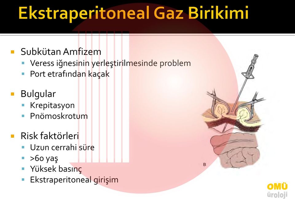 Bulgular Krepitasyon Pnömoskrotum Risk faktörleri