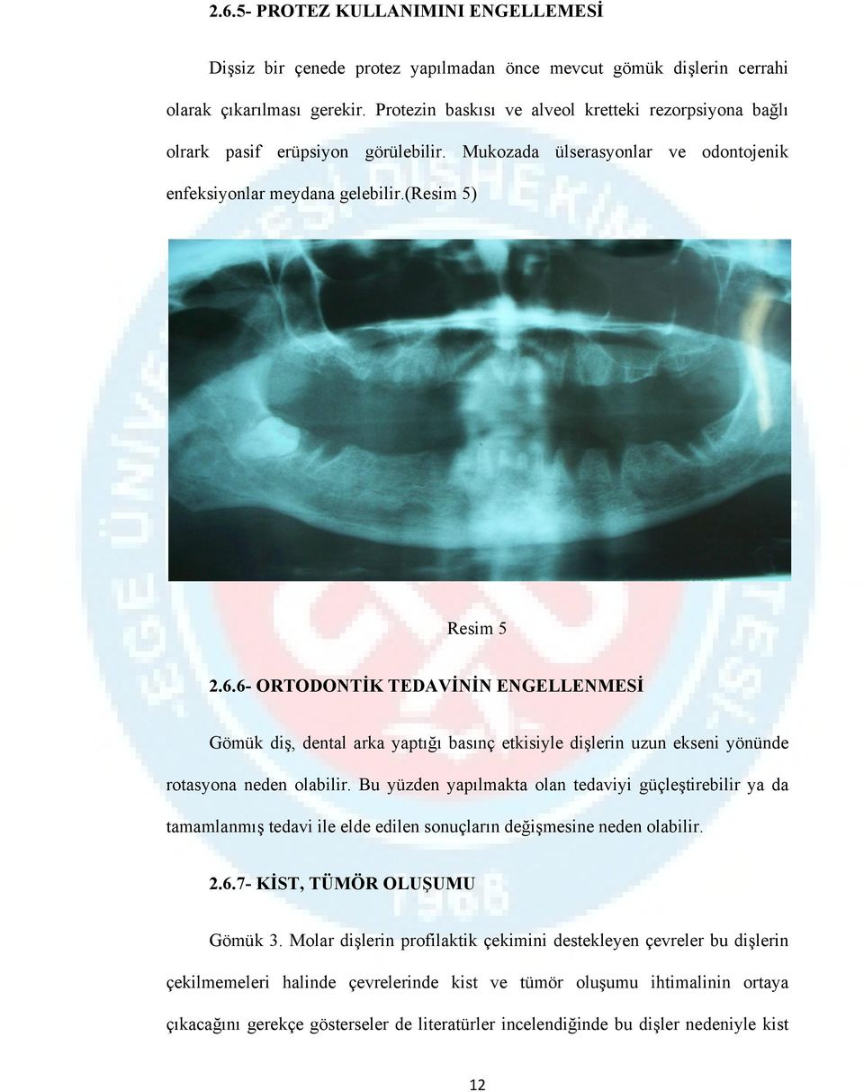 6- ORTODONTİK TEDAVİNİN ENGELLENMESİ Gömük diş, dental arka yaptığı basınç etkisiyle dişlerin uzun ekseni yönünde rotasyona neden olabilir.