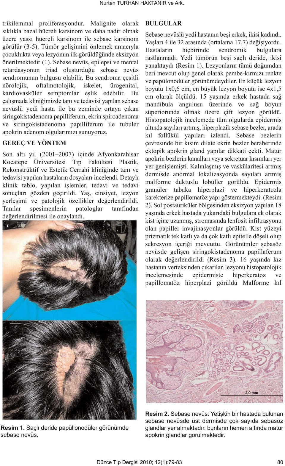 Sebase nevüs, epilepsi ve mental retardasyonun triad oluşturduğu sebase nevüs sendromunun bulgusu olabilir.