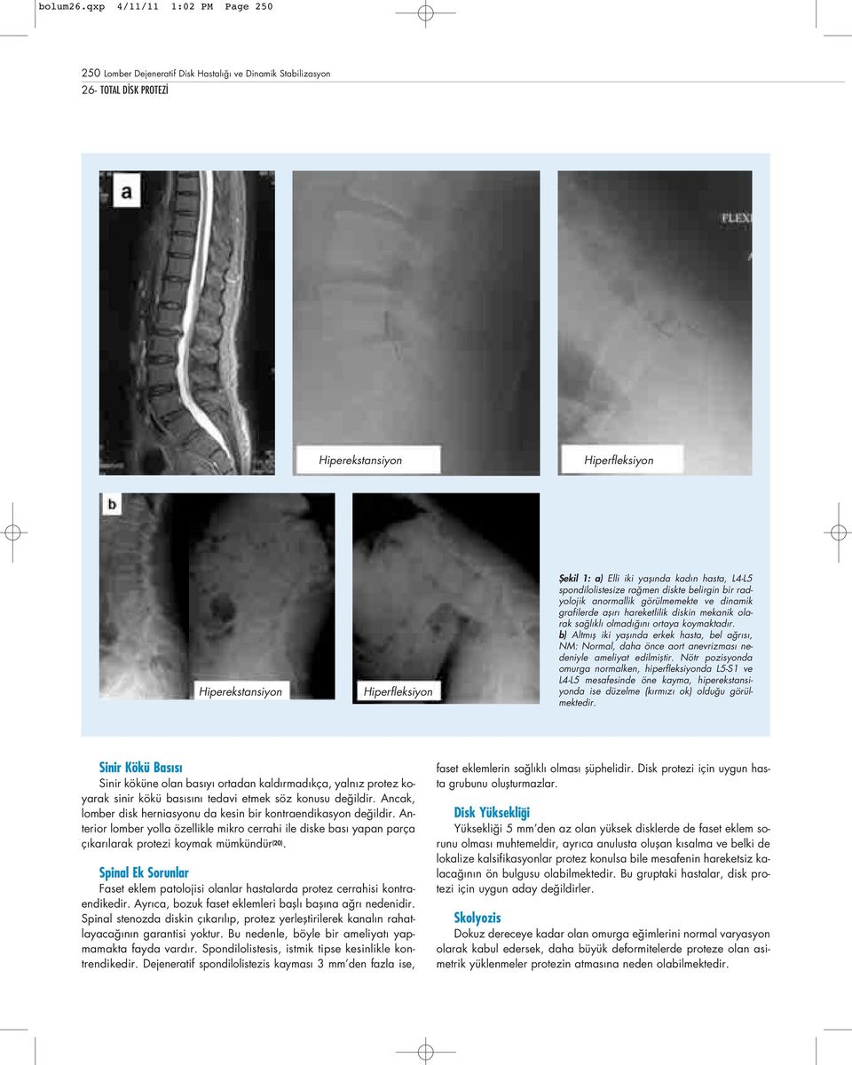 yafl nda kad n hasta, L4-L5 spondilolistesize ra men diskte belirgin bir radyolojik anormallik görülmemekte ve dinamik grafilerde afl r hareketlilik diskin mekanik olarak sa l kl olmad n ortaya