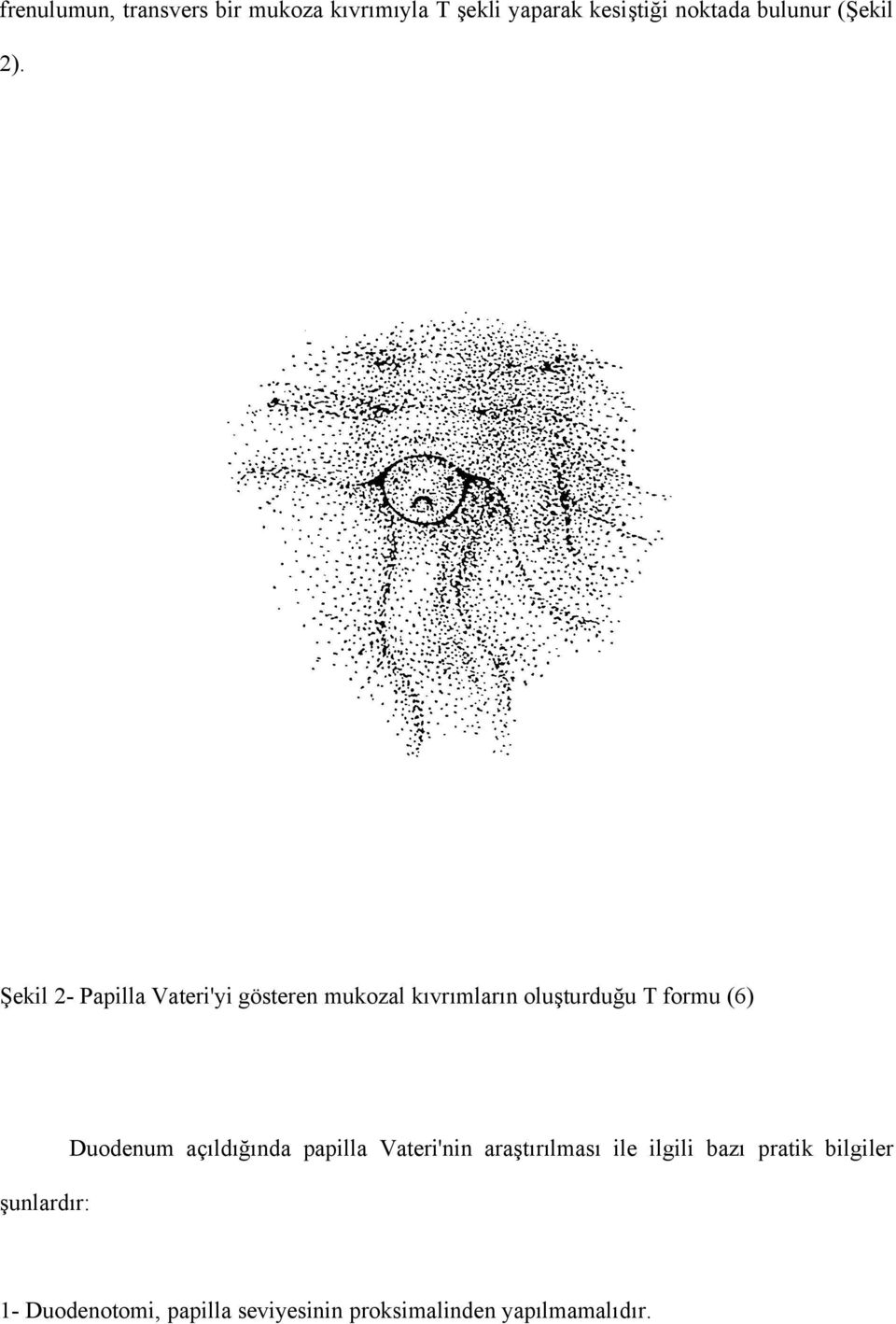 Şekil 2- Papilla Vateri'yi gösteren mukozal kıvrımların oluşturduğu T formu (6)