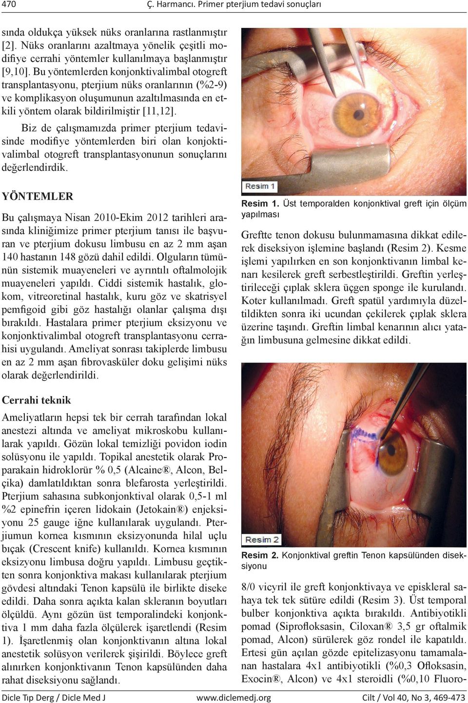 Bu yöntemlerden konjonktivalimbal otogreft transplantasyonu, pterjium nüks oranlarının (%2-9) ve komplikasyon oluşumunun azaltılmasında en etkili yöntem olarak bildirilmiştir [11,12].