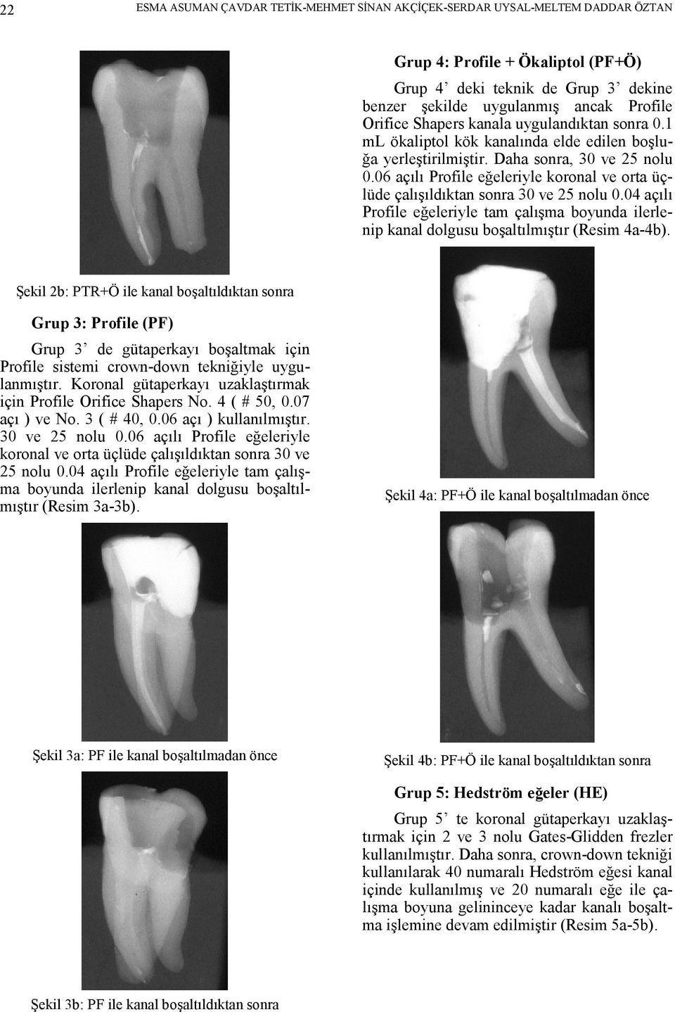 06 açılı Profile eğeleriyle koronal ve orta üçlüde çalışıldıktan sonra 30 ve 25 nolu 0.04 açılı Profile eğeleriyle tam çalışma boyunda ilerlenip kanal dolgusu boşaltılmıştır (Resim 4a-4b).