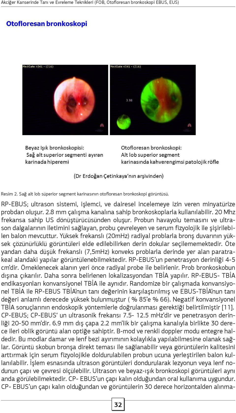 20 Mhz frekansa sahip US dönüştürücüsünden oluşur. Probun havayolu temasını ve ultrason dalgalarının iletimini sağlayan, probu çevreleyen ve serum fizyolojik ile şişirilebilen balon mevcuttur.