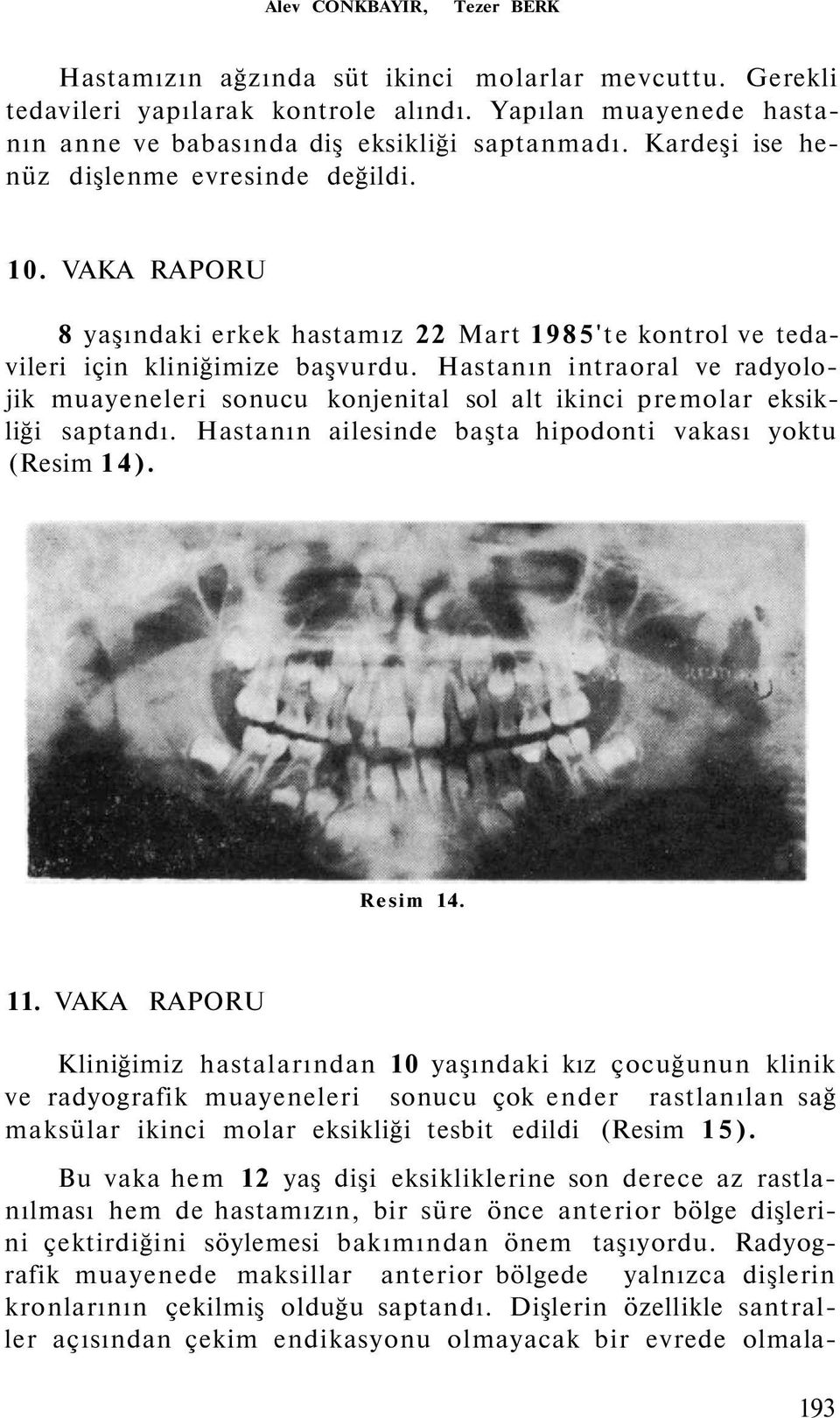 Hastanın intraoral ve radyolojik muayeneleri sonucu konjenital sol alt ikinci premolar eksikliği saptandı. Hastanın ailesinde başta hipodonti vakası yoktu (Resim 14). Resim 14. 11.