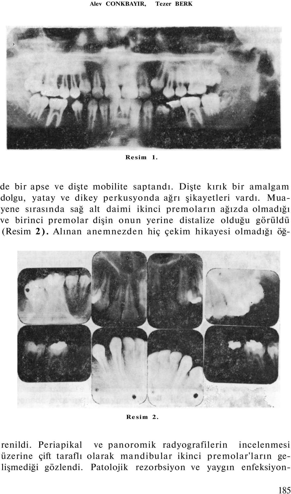 Muayene sırasında sağ alt daimi ikinci premoların ağızda olmadığı ve birinci premolar dişin onun yerine distalize olduğu görüldü (Resim