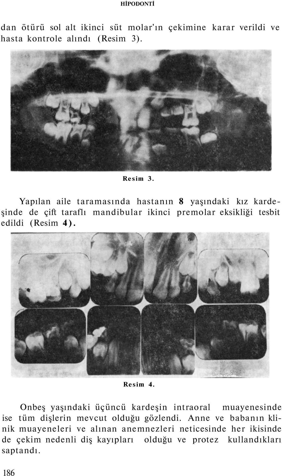 (Resim 4). Resim 4. Onbeş yaşındaki üçüncü kardeşin intraoral muayenesinde ise tüm dişlerin mevcut olduğu gözlendi.