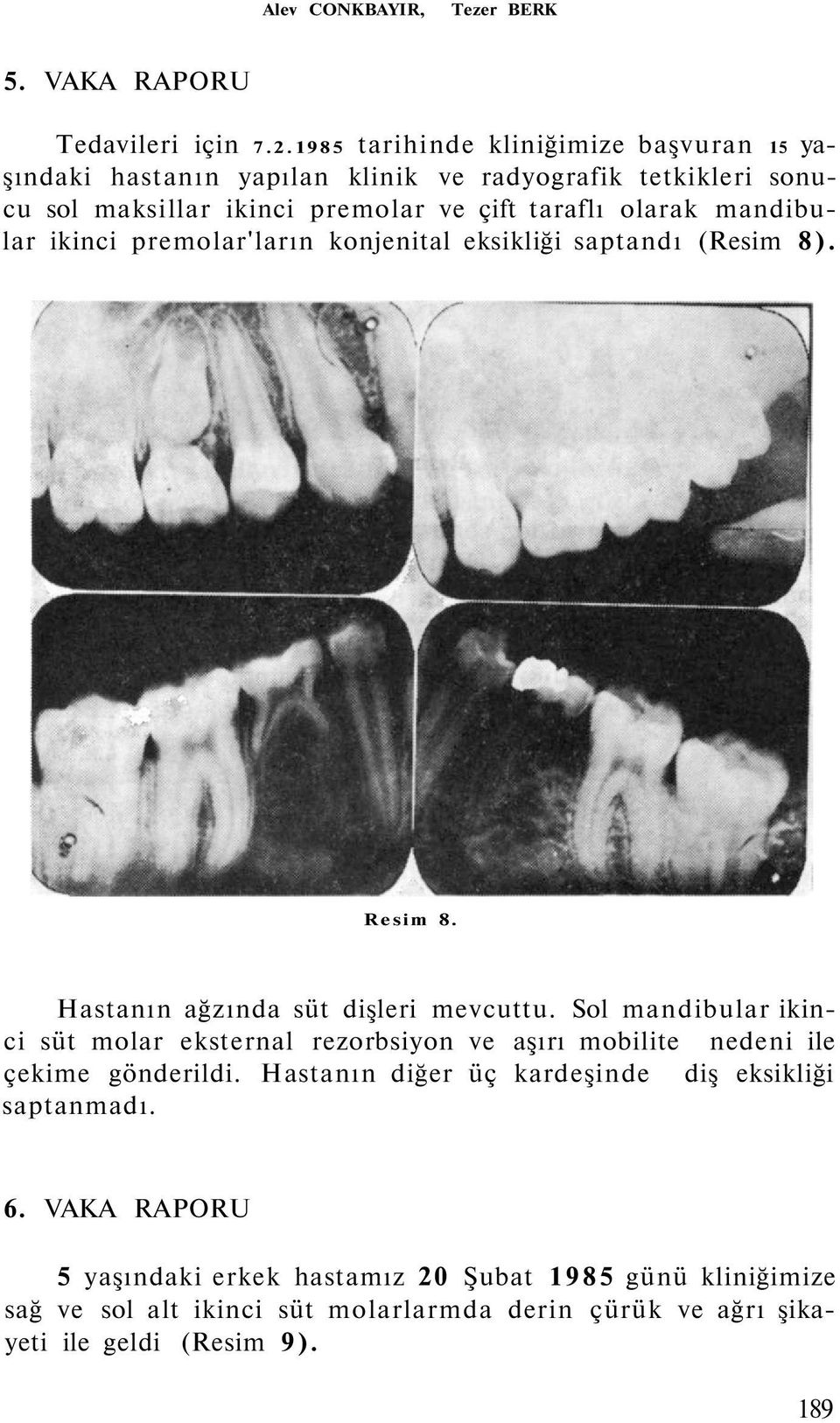mandibular ikinci premolar'ların konjenital eksikliği saptandı (Resim 8). Resim 8. Hastanın ağzında süt dişleri mevcuttu.