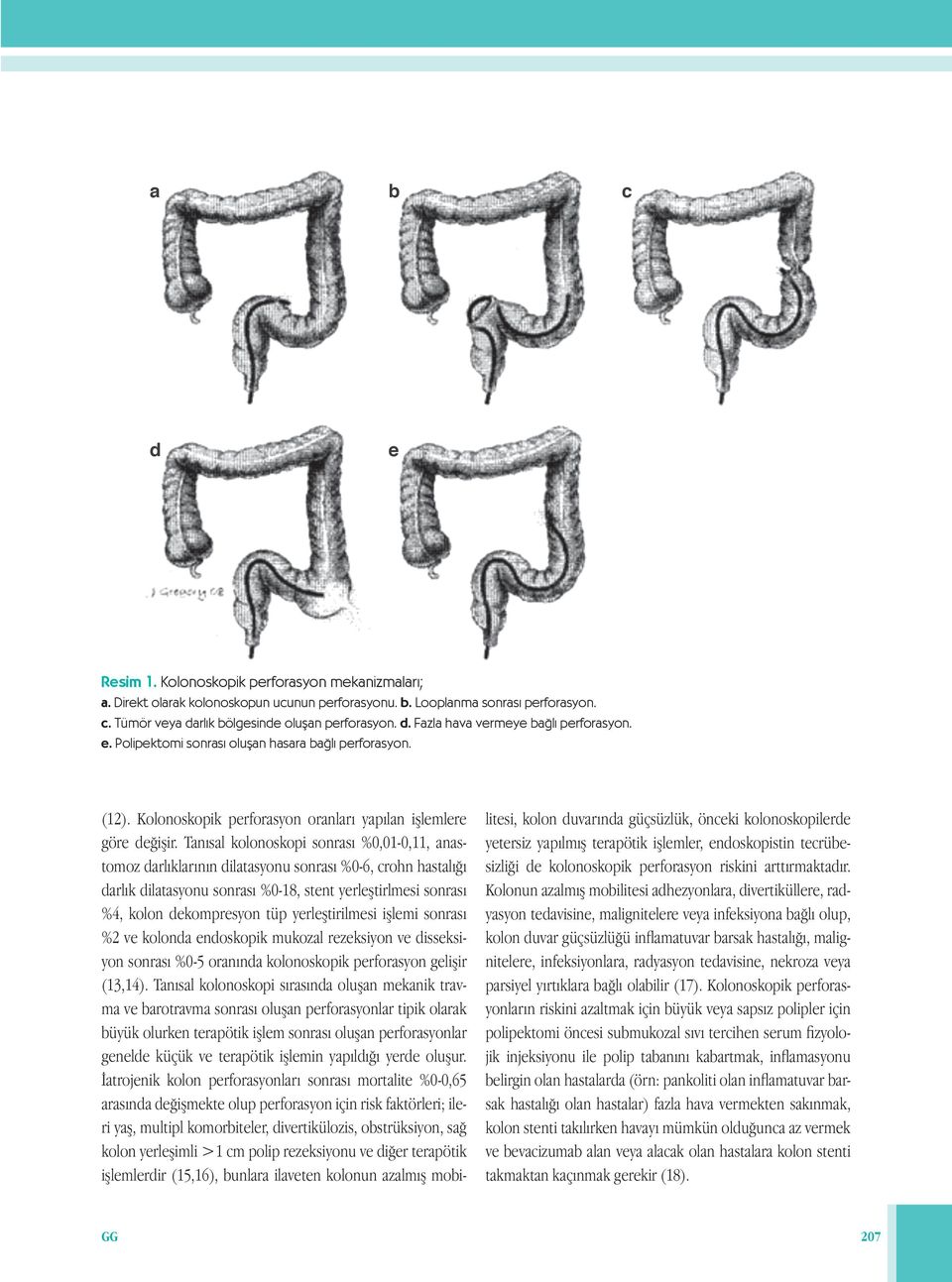 Tanısal kolonoskopi sonrası %0,01-0,11, anastomoz darlıklarının dilatasyonu sonrası %0-6, crohn hastalığı darlık dilatasyonu sonrası %0-18, stent yerleştirlmesi sonrası %4, kolon dekompresyon tüp