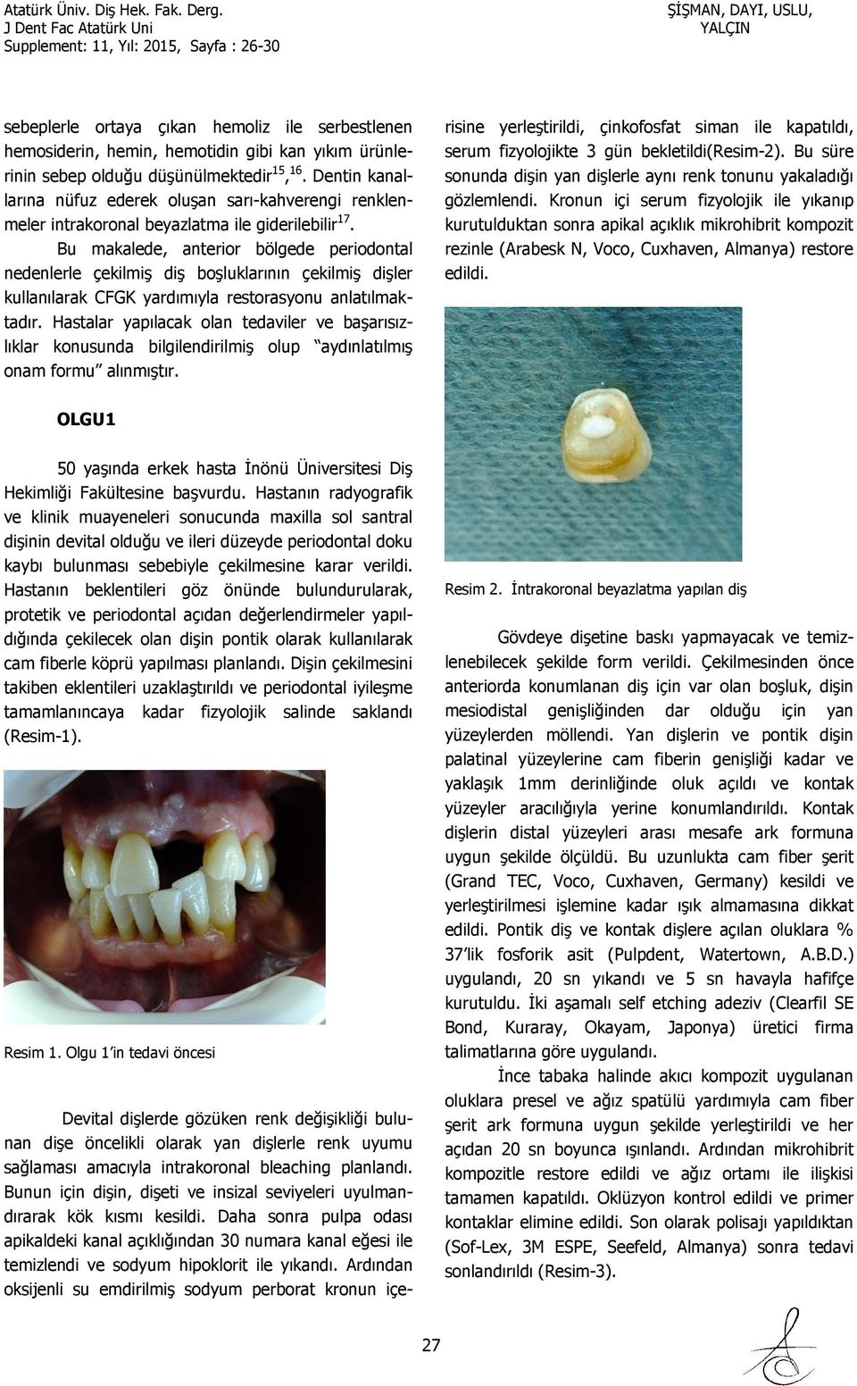 Bu makalede, anterior bölgede periodontal nedenlerle çekilmiş diş boşluklarının çekilmiş dişler kullanılarak CFGK yardımıyla restorasyonu anlatılmaktadır.