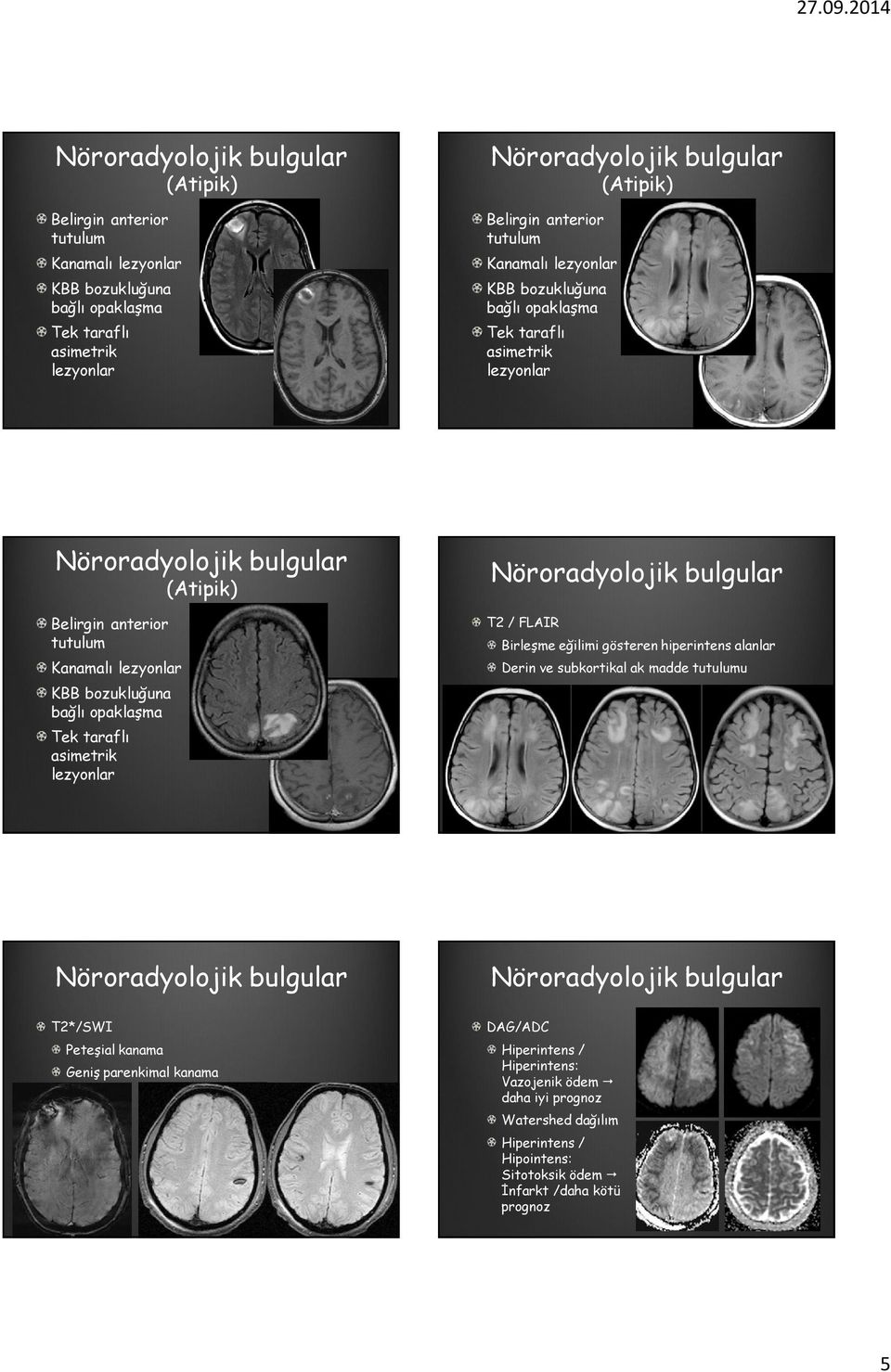 taraflı asimetrik lezyonlar T2 / FLAIR Birleşme eğilimi gösteren hiperintens alanlar Derin ve subkortikal ak madde tutulumu T2*/SWI Peteşial kanama Geniş