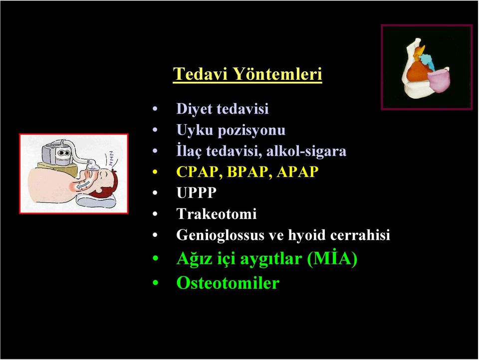 BPAP, APAP UPPP Trakeotomi Genioglossus ve