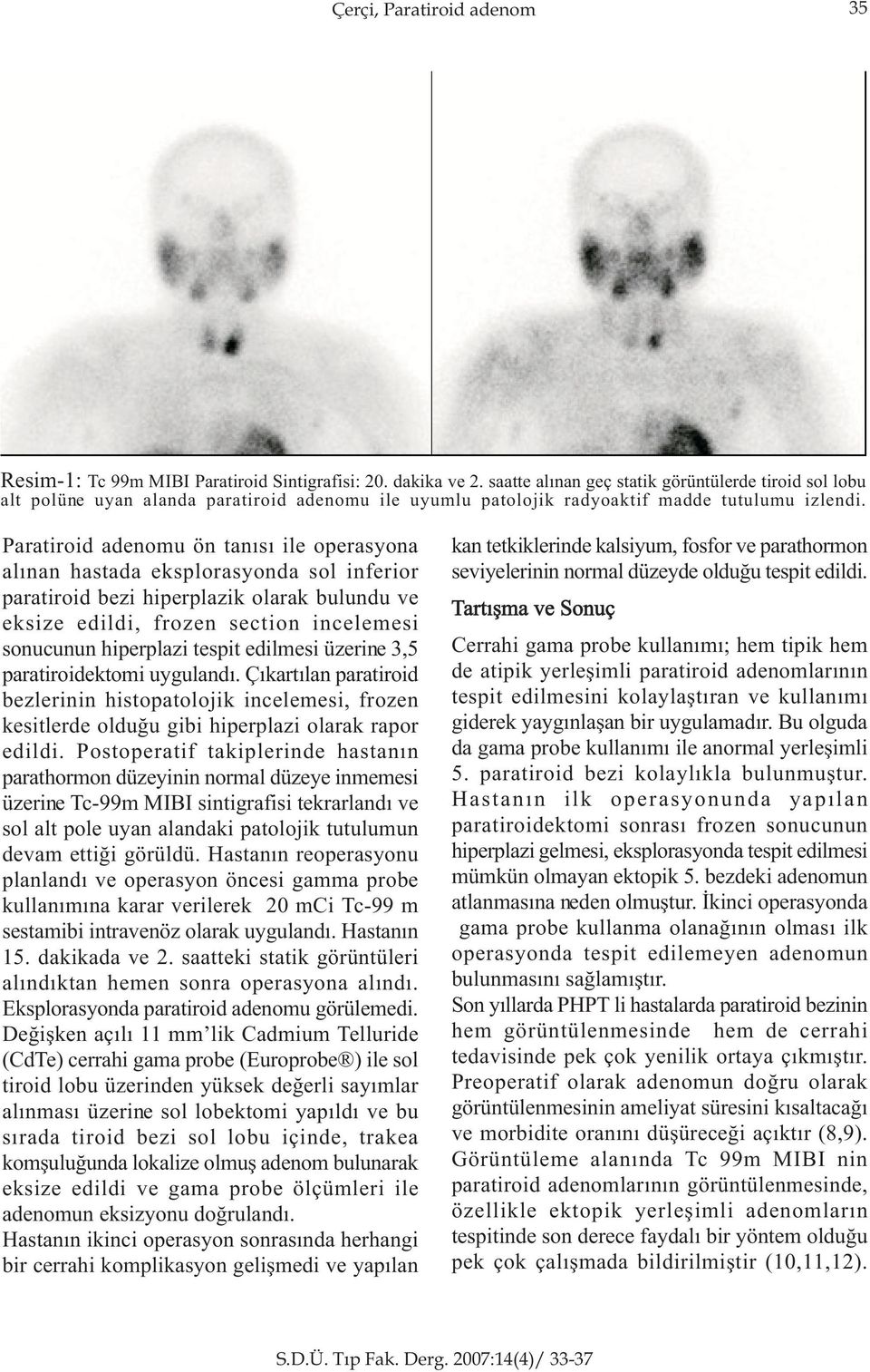 Paratiroid adenomu ön tanýsý ile operasyona alýnan hastada eksplorasyonda sol inferior paratiroid bezi hiperplazik olarak bulundu ve eksize edildi, frozen section incelemesi sonucunun hiperplazi