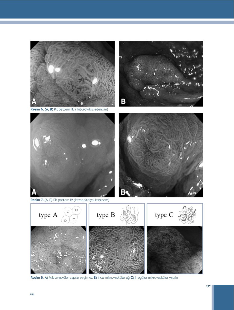 (A, B) Pit pattern IV (intraepitelyal karsinom) Resim