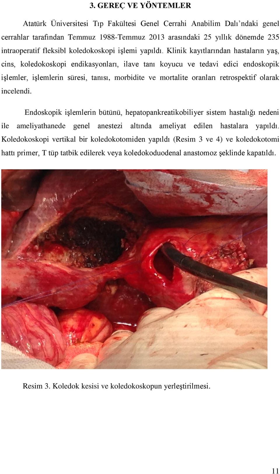 Klinik kayıtlarından hastaların yaş, cins, koledokoskopi endikasyonları, ilave tanı koyucu ve tedavi edici endoskopik işlemler, işlemlerin süresi, tanısı, morbidite ve mortalite oranları retrospektif