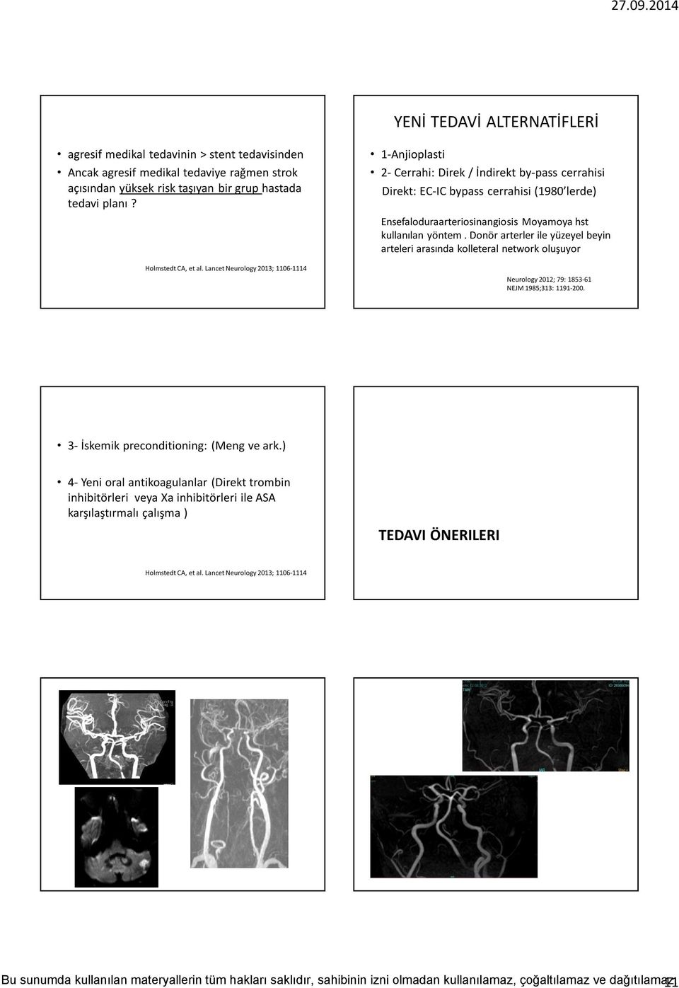 Donör arterler ile yüzeyel beyin arteleri arasında kolleteral network oluşuyor Neurology 2012; 79: 1853-61 NEJM 1985;313: 1191-200. 3- İskemik preconditioning: (Meng ve ark.