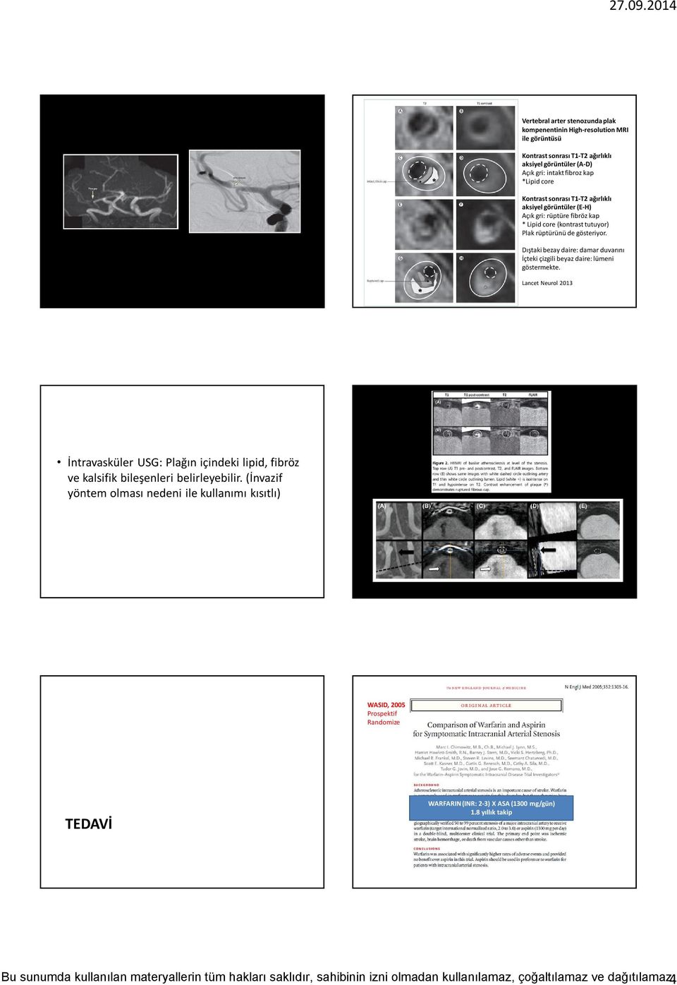 Dıştaki bezay daire: damar duvarını İçteki çizgili beyaz daire: lümeni göstermekte. Lancet Neurol 2013 İntravasküler USG: Plağın içindeki lipid, fibröz ve kalsifik bileşenleri belirleyebilir.