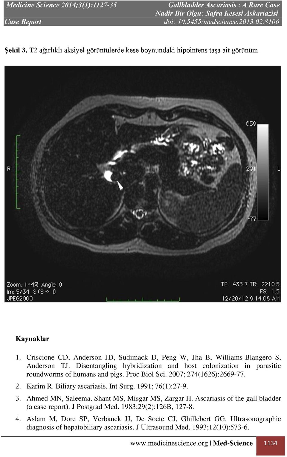 Disentangling hybridization and host colonization in parasitic roundworms of humans and pigs. Proc Biol Sci. 2007; 274(1626):2669-77. 2. Karim R. Biliary ascariasis. Int Surg.