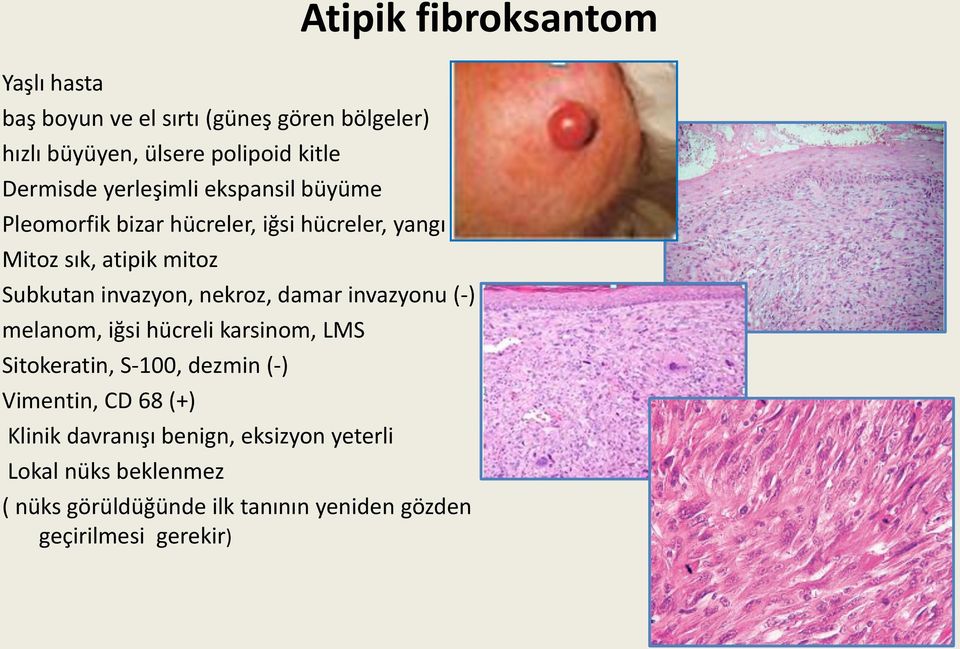 invazyonu (-) melanom, iğsi hücreli karsinom, LMS Sitokeratin, S-100, dezmin (-) Vimentin, CD 68 (+) Klinik davranışı