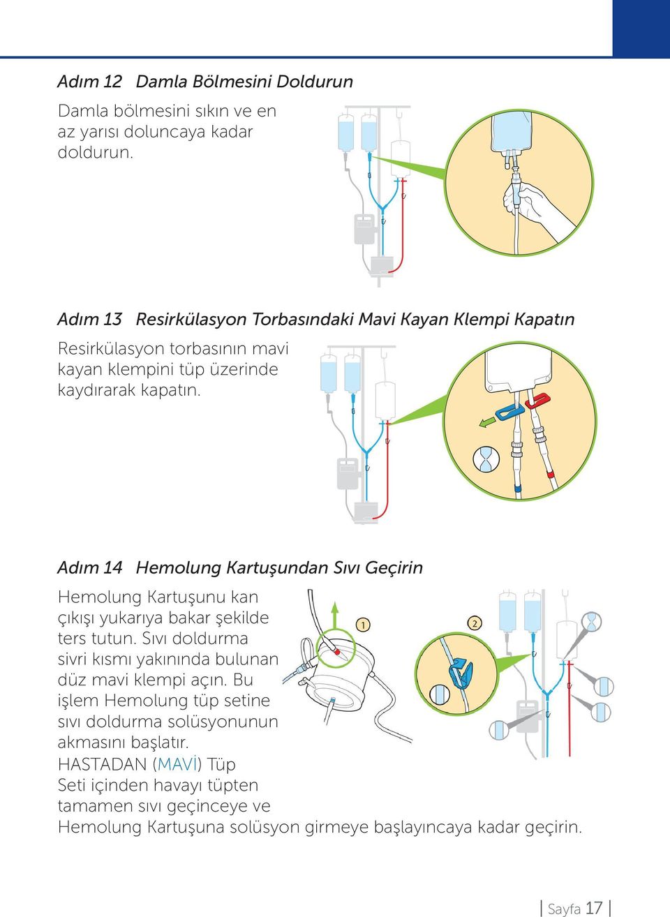 Adım 14 Hemolung Kartuşundan Sıvı Geçirin Hemolung Kartuşunu kan çıkışı yukarıya bakar şekilde ters tutun.