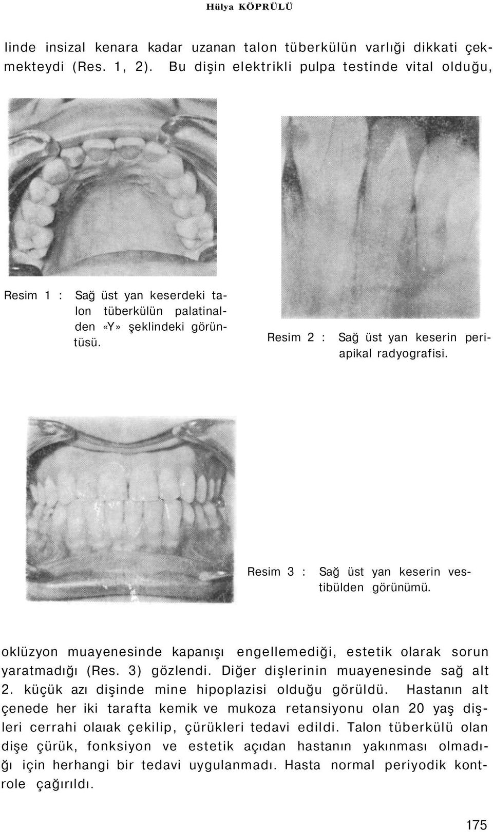 Resim 3 : Sağ üst yan keserin vestibülden görünümü. oklüzyon muayenesinde kapanışı engellemediği, estetik olarak sorun yaratmadığı (Res. 3) gözlendi. Diğer dişlerinin muayenesinde sağ alt 2.