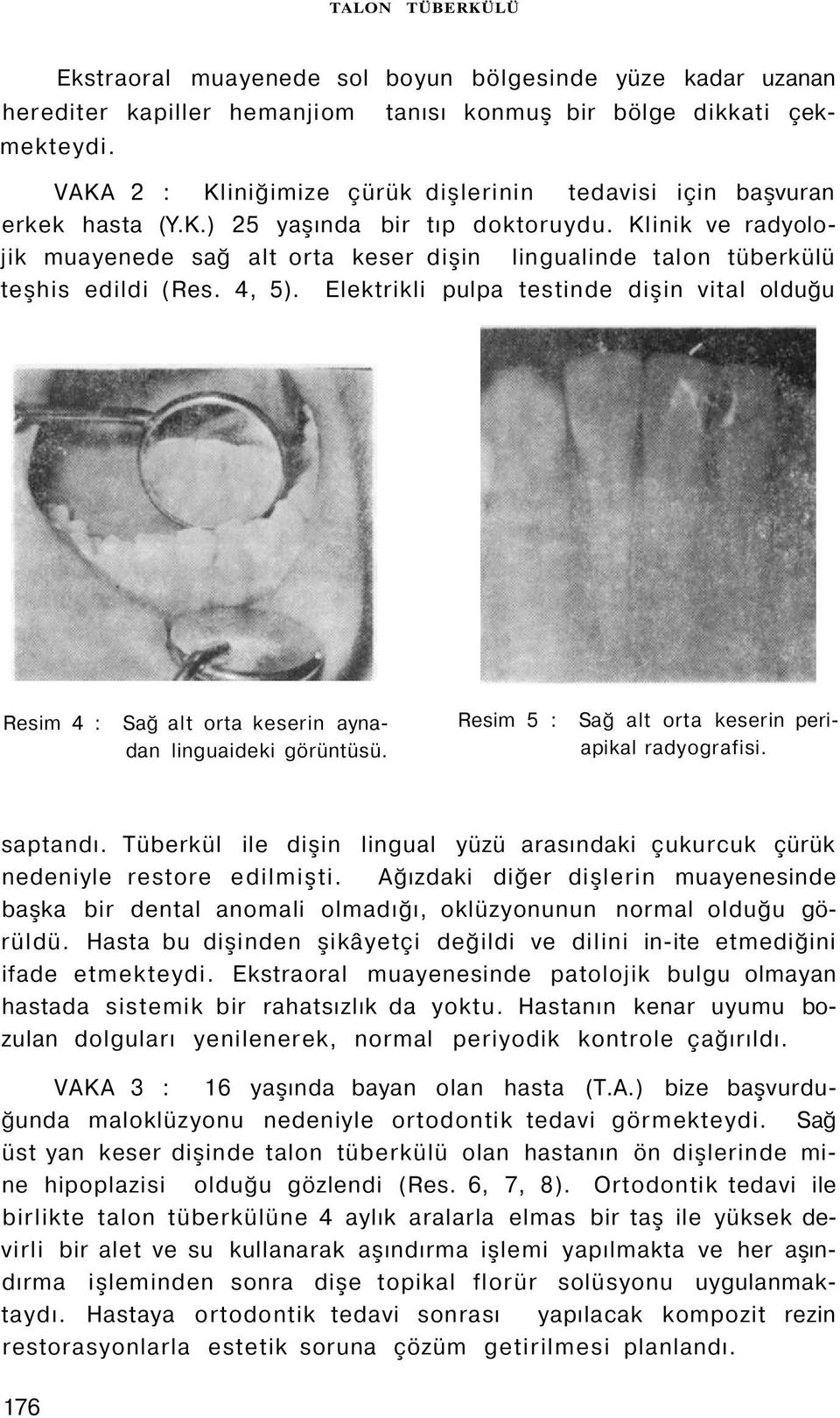 Klinik ve radyolojik muayenede sağ alt orta keser dişin lingualinde talon tüberkülü teşhis edildi (Res. 4, 5).