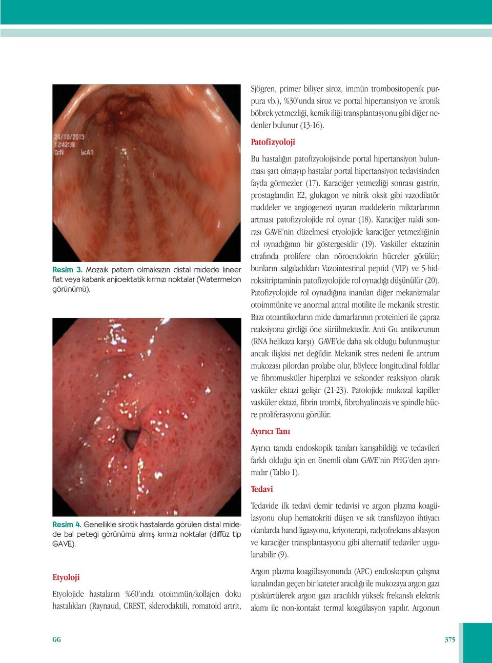 Etyoloji Etyolojide hastaların %60 ında otoimmün/kollajen doku hastalıkları (Raynaud, CREST, sklerodaktili, romatoid artrit, Sjögren, primer biliyer siroz, immün trombositopenik purpura vb.