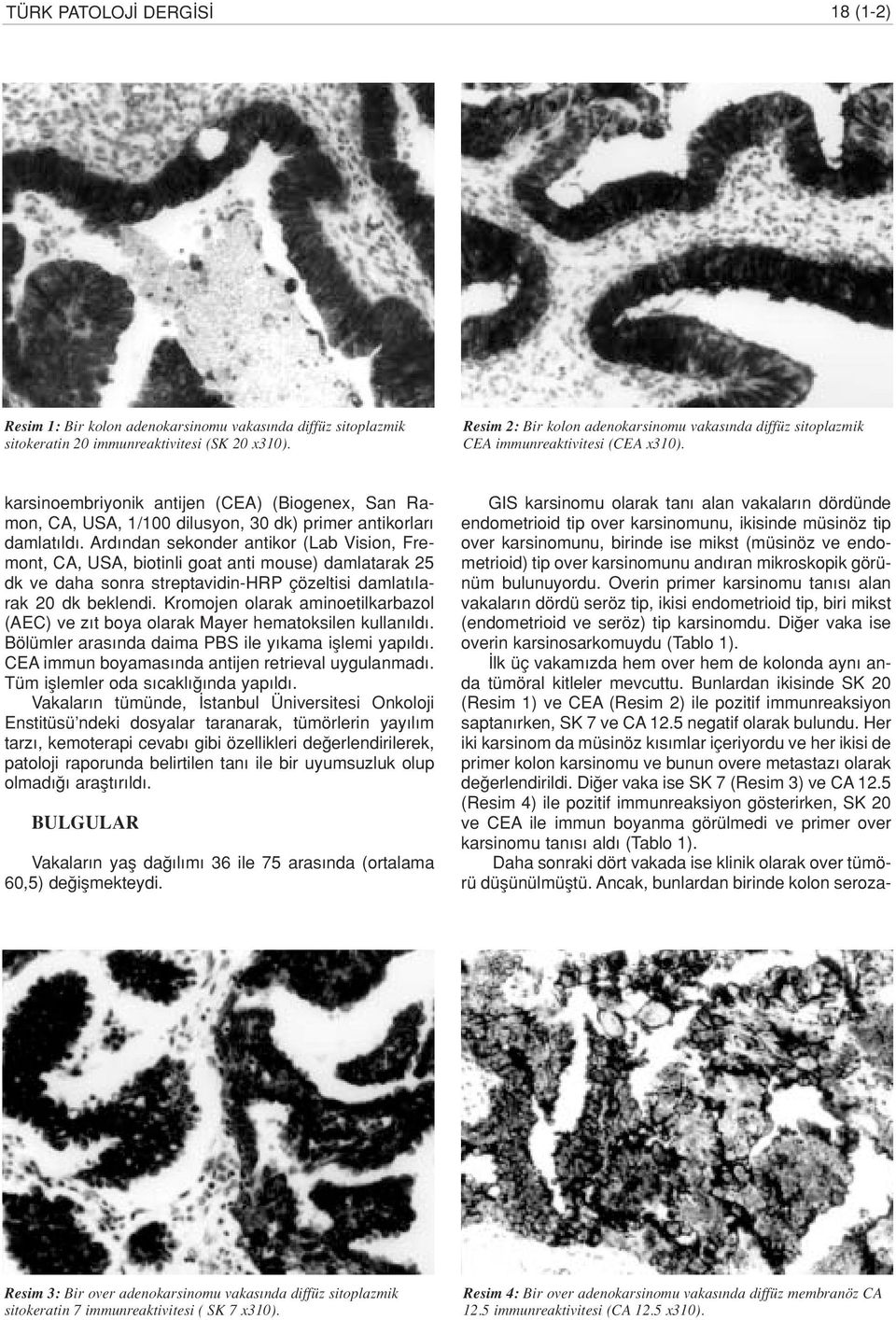 karsinoembriyonik antijen (CA) (Biogenex, an Ramon, CA, UA, 1/100 dilusyon, 30 dk) primer antikorlar damlat ld.