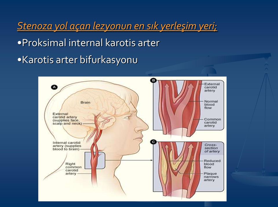 Proksimal internal karotis