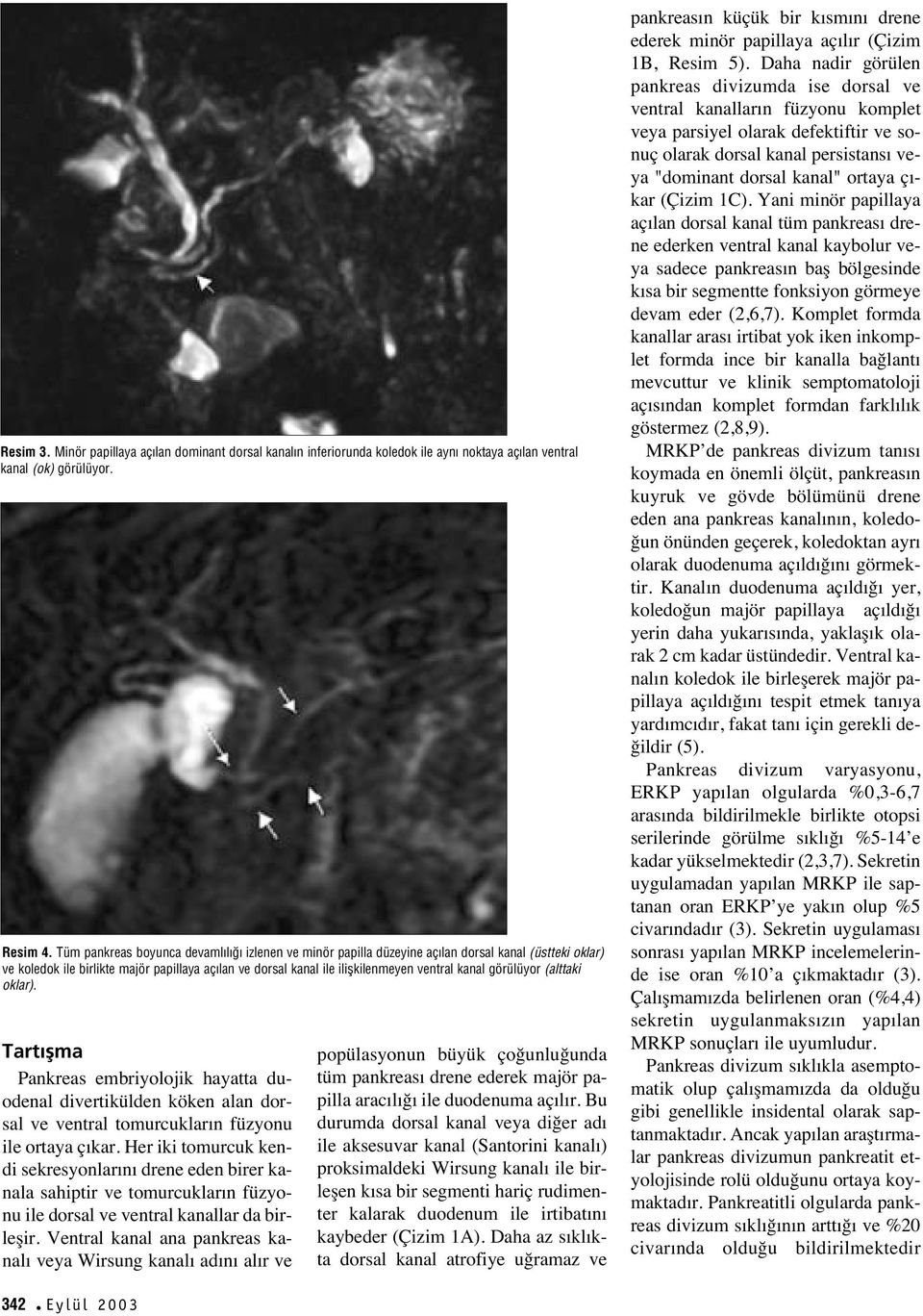 görülüyor (alttaki oklar). Tart flma Pankreas embriyolojik hayatta duodenal divertikülden köken alan dorsal ve ventral tomurcuklar n füzyonu ile ortaya ç kar.