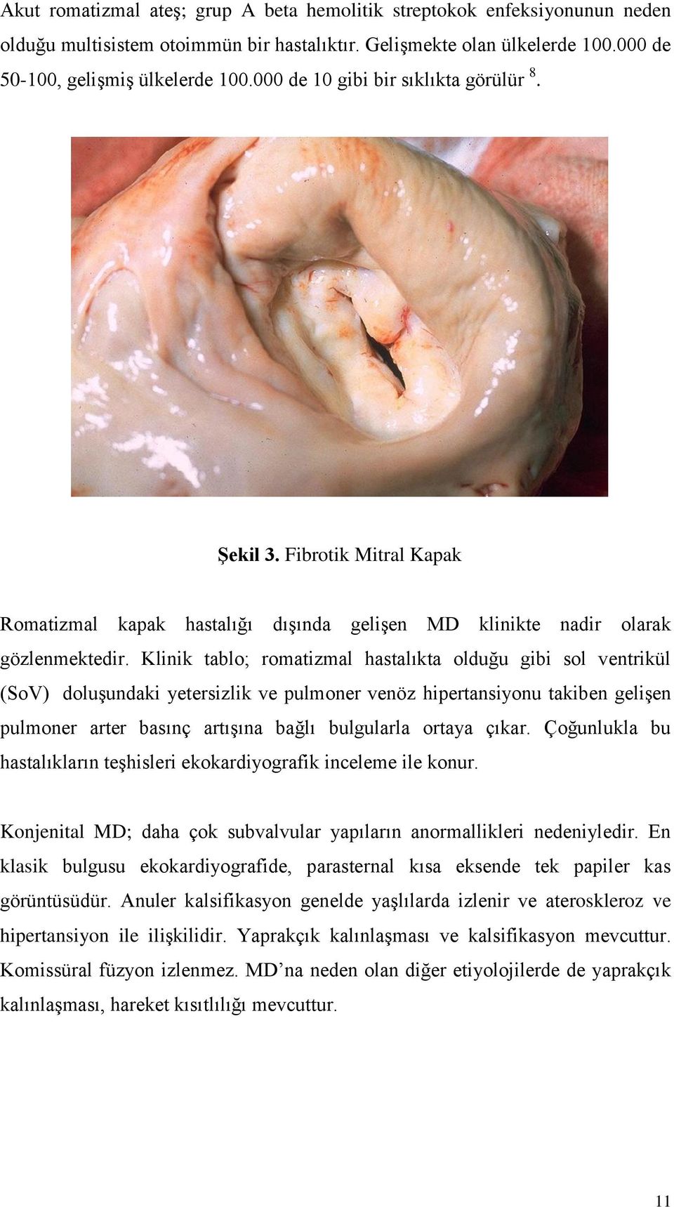 Klinik tablo; romatizmal hastalıkta olduğu gibi sol ventrikül (SoV) doluşundaki yetersizlik ve pulmoner venöz hipertansiyonu takiben gelişen pulmoner arter basınç artışına bağlı bulgularla ortaya